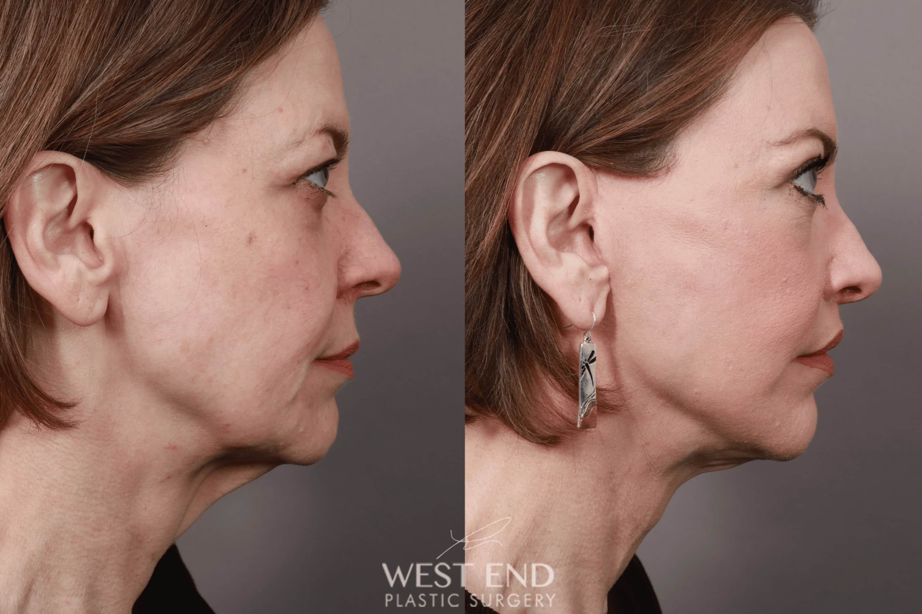 Deep Plane Facelift & Neck Lift, Lip Lift, Eyelid Lift, Brow Lift, Fat Grafting, and CO2 Resurfacing (1.5 Months Post-Op) before photo. Individual results may vary.