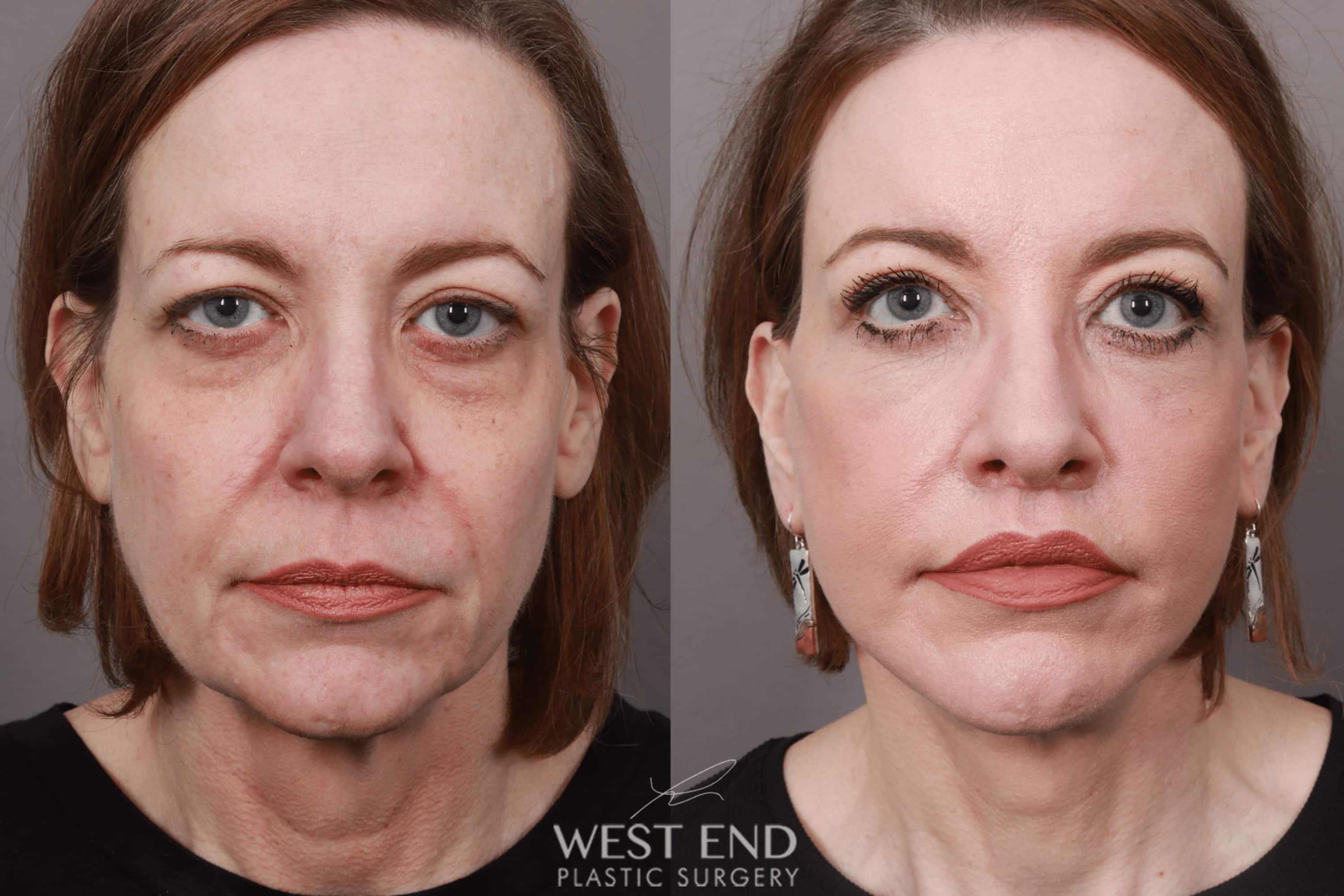 Lip Lift (1.5 Months Post-Op)