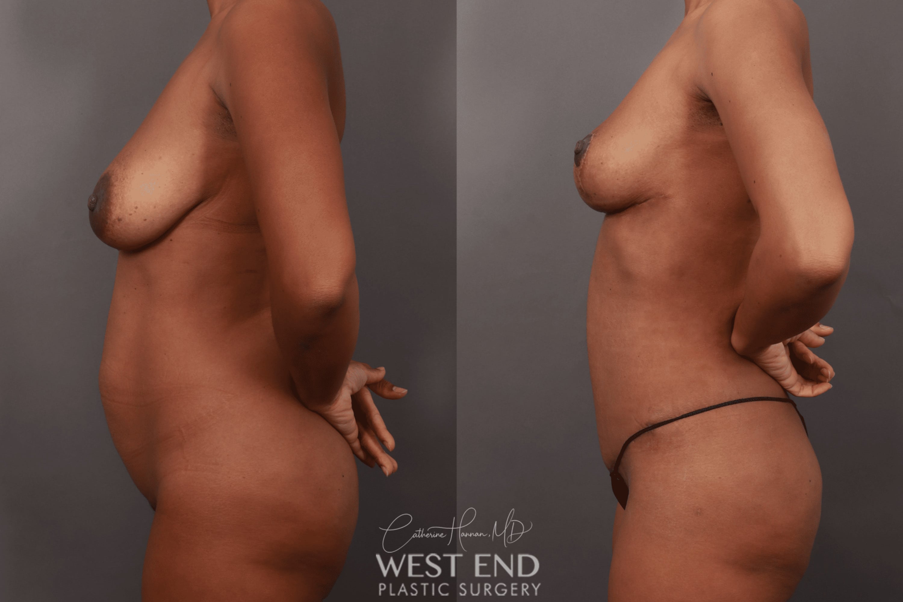 Mommy Makeover (Tummy Tuck, Breast Lift, & Liposuction)