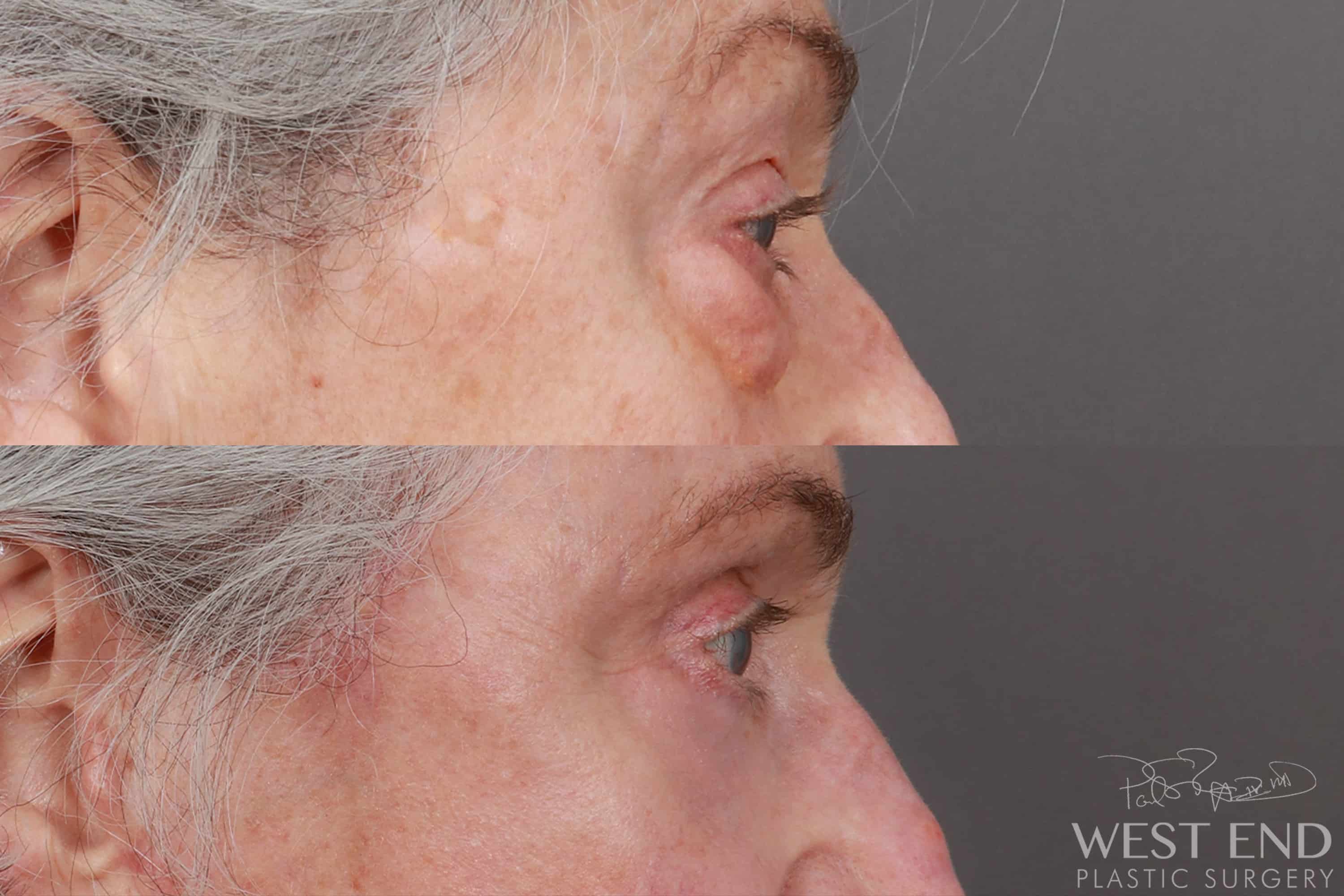 Lower & Upper Blepharoplasty (3 Months Post-op)