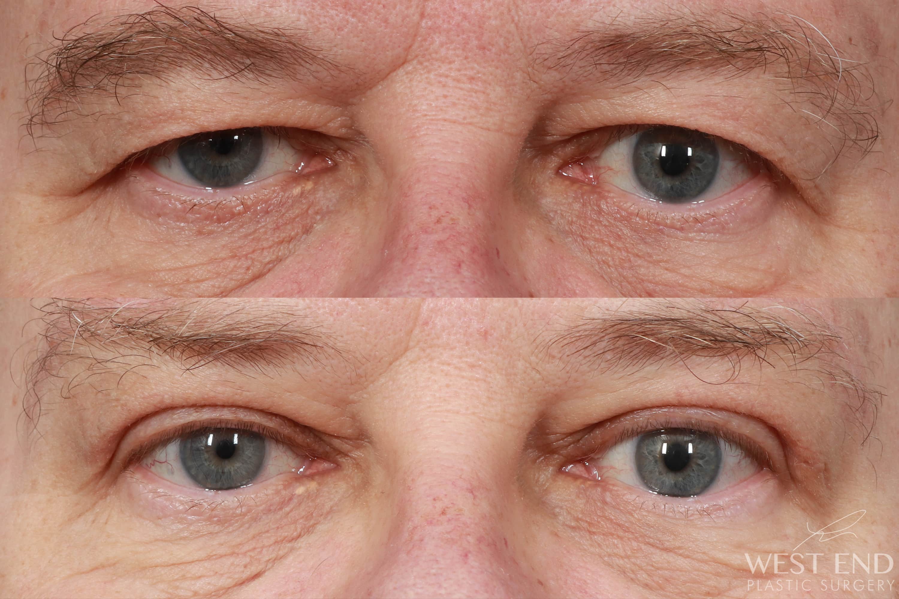Upper Eyelid Lift And Brow Lift 2 Weeks Post Op Case 10348 West End
