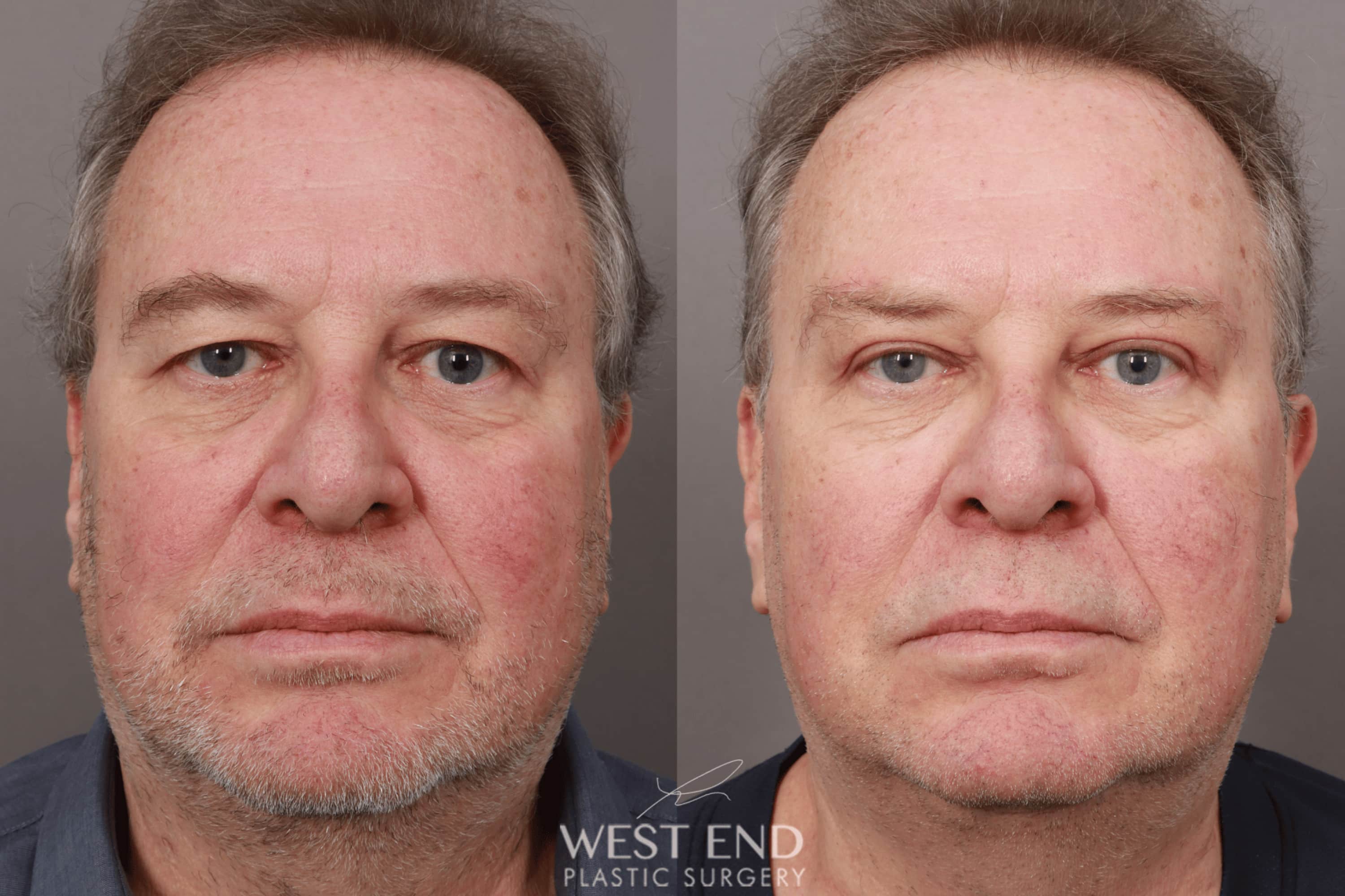 Upper Eyelid Lift & Brow Lift (2 weeks post-op)