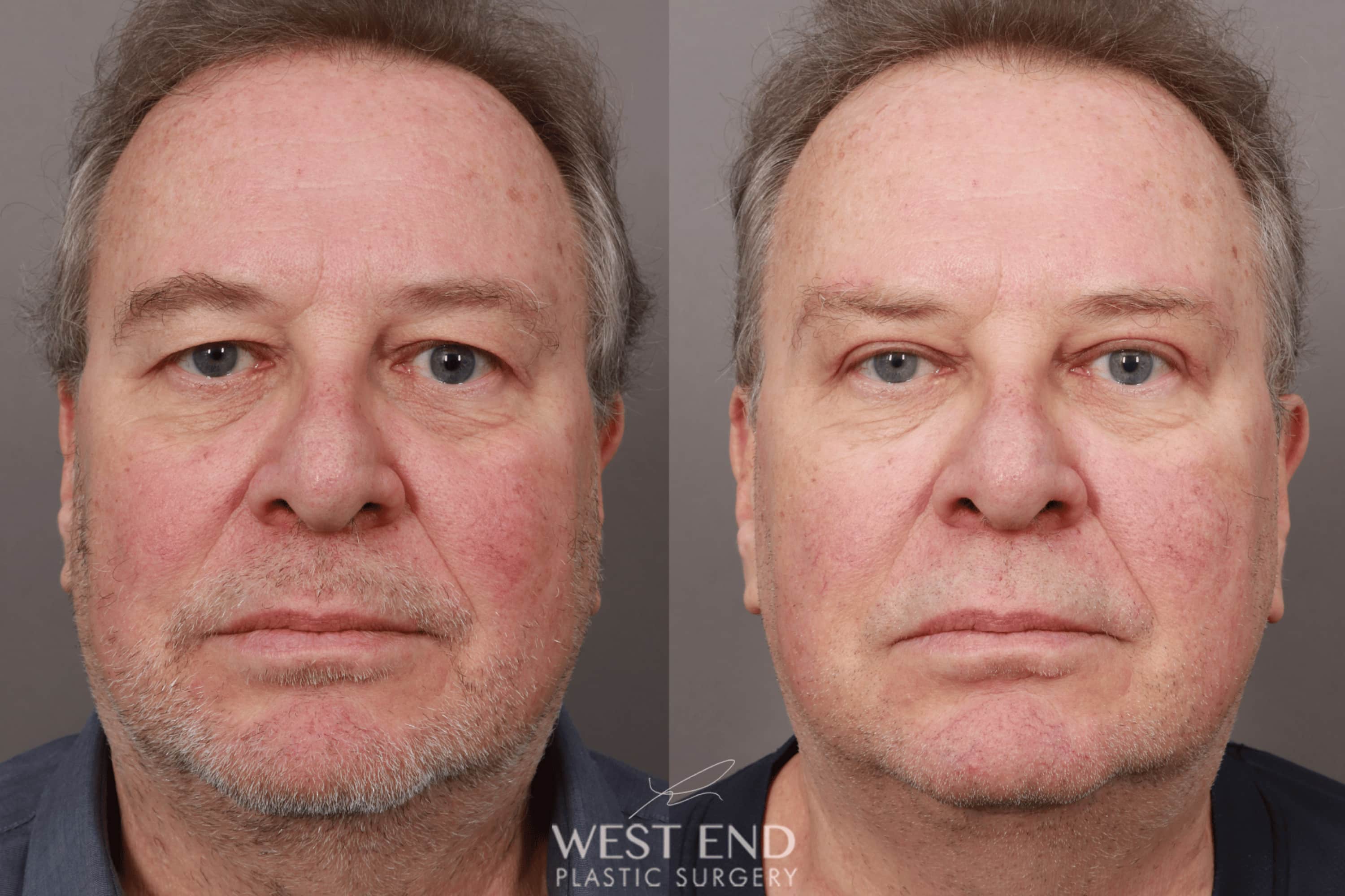 Brow Lift & Upper Eyelid Lift (2 weeks post-op) before photo. Individual results may vary.