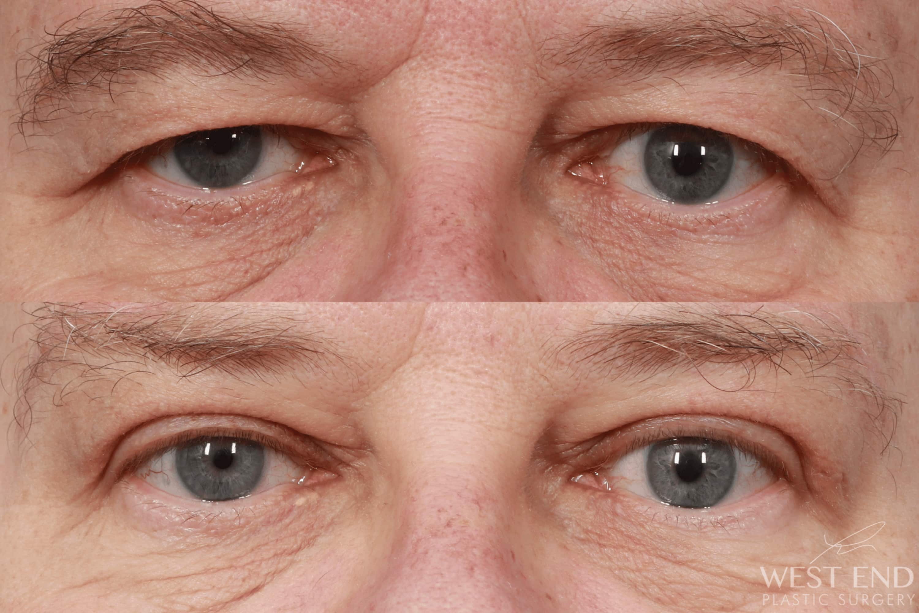 Brow Lift & Upper Eyelid Lift (2 weeks post-op) before photo. Individual results may vary.