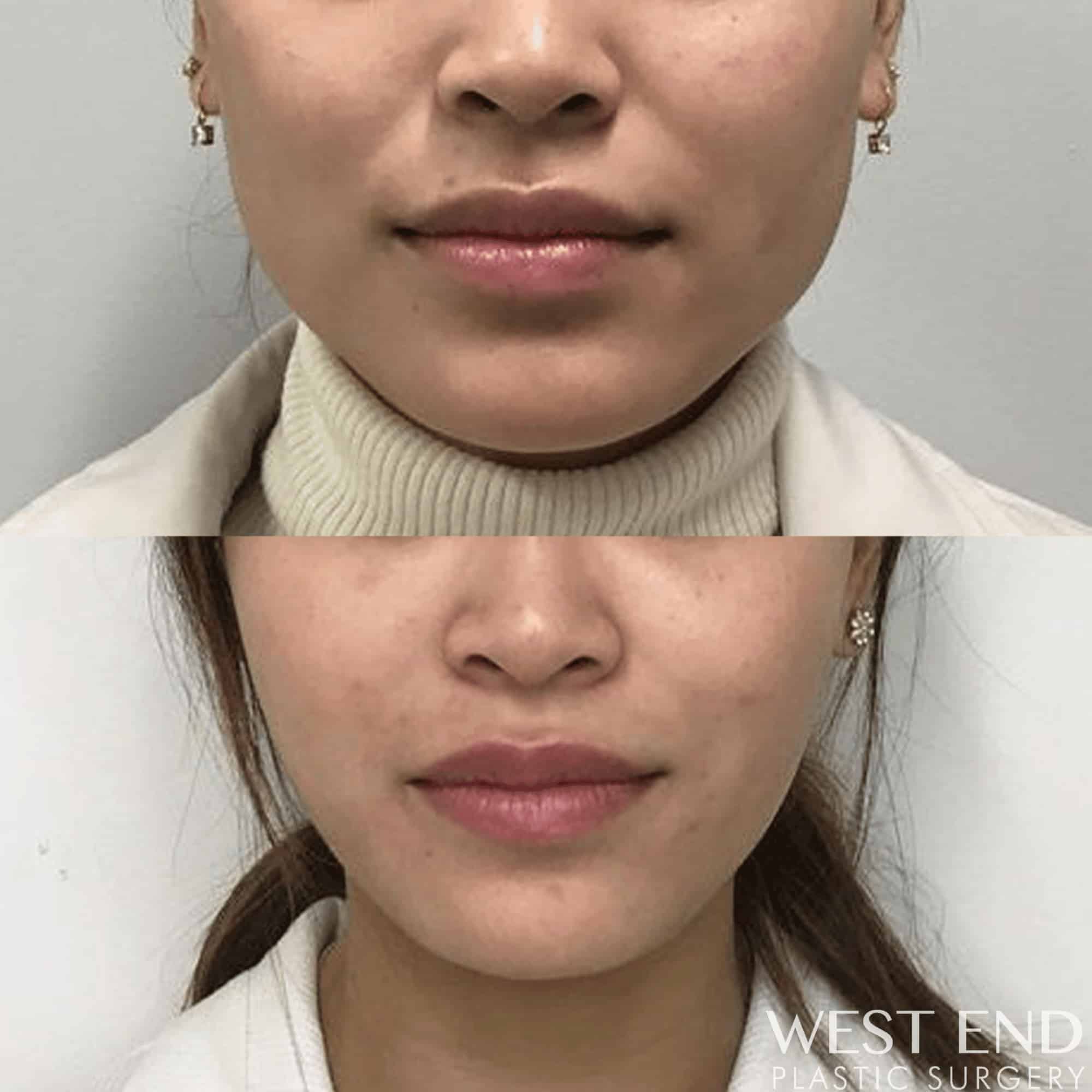 Botox in the Masseter Muscle (Jaw Clenching)