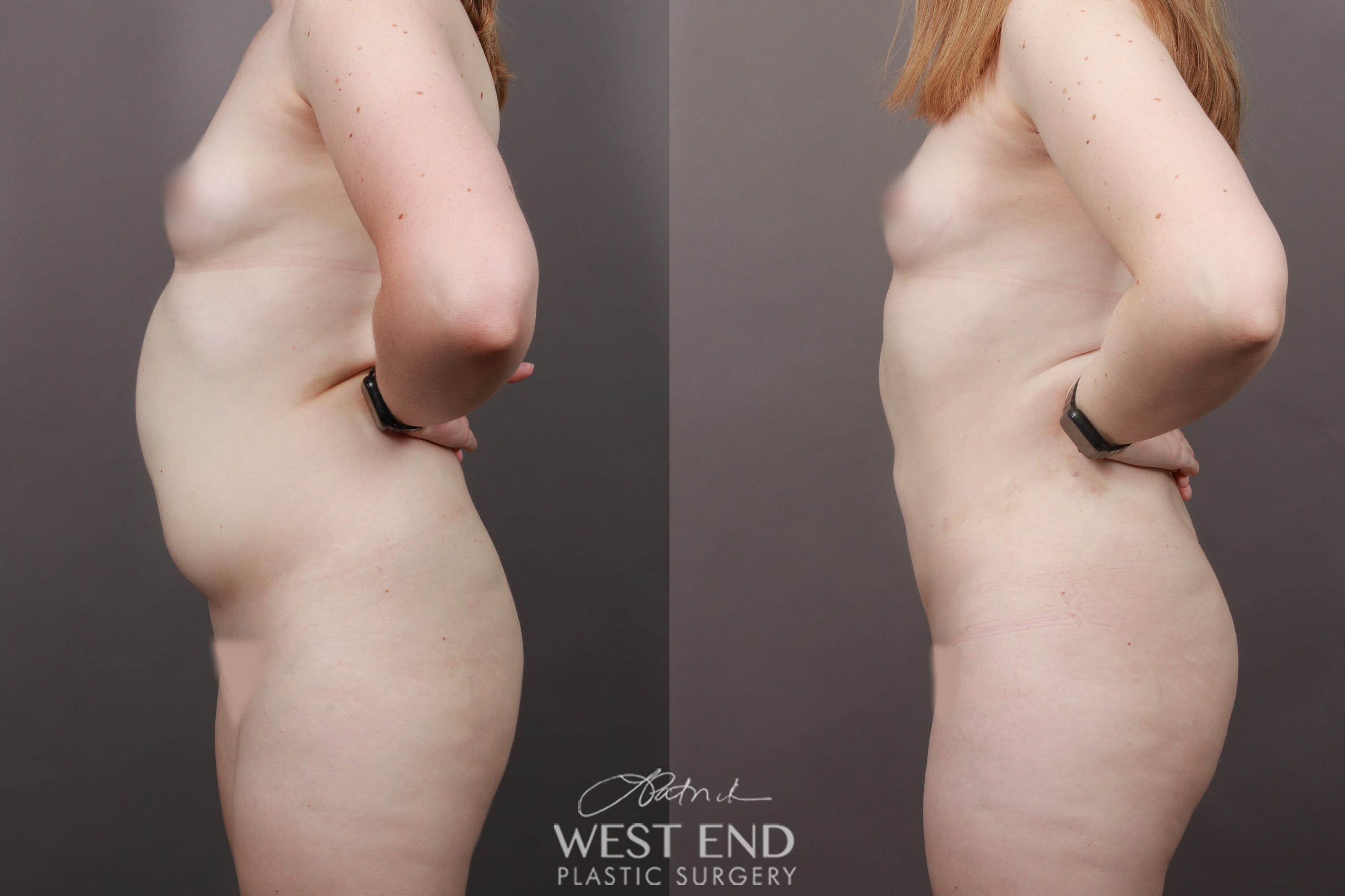 Liposuction (5 Months Post-Op)