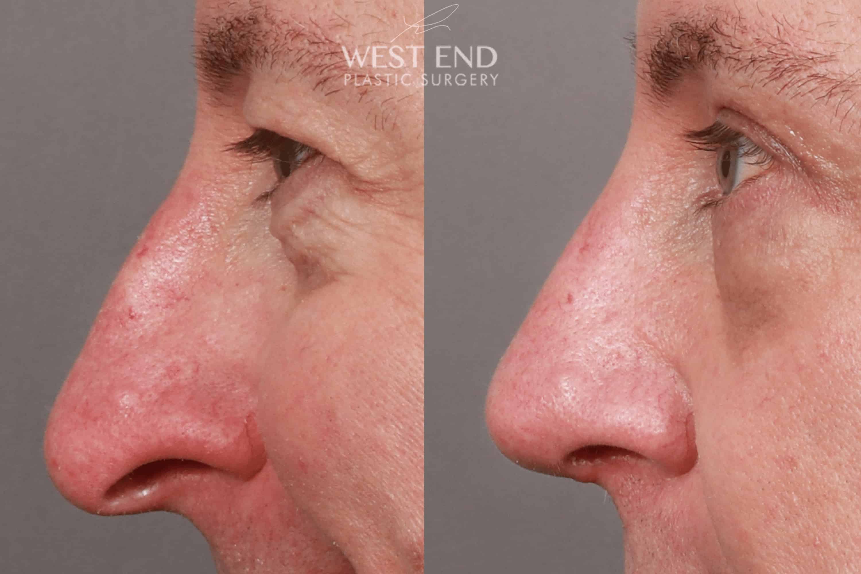 Open Septorhinoplasty with ClariFix (1 Month Post-Op) before photo. Individual results may vary.