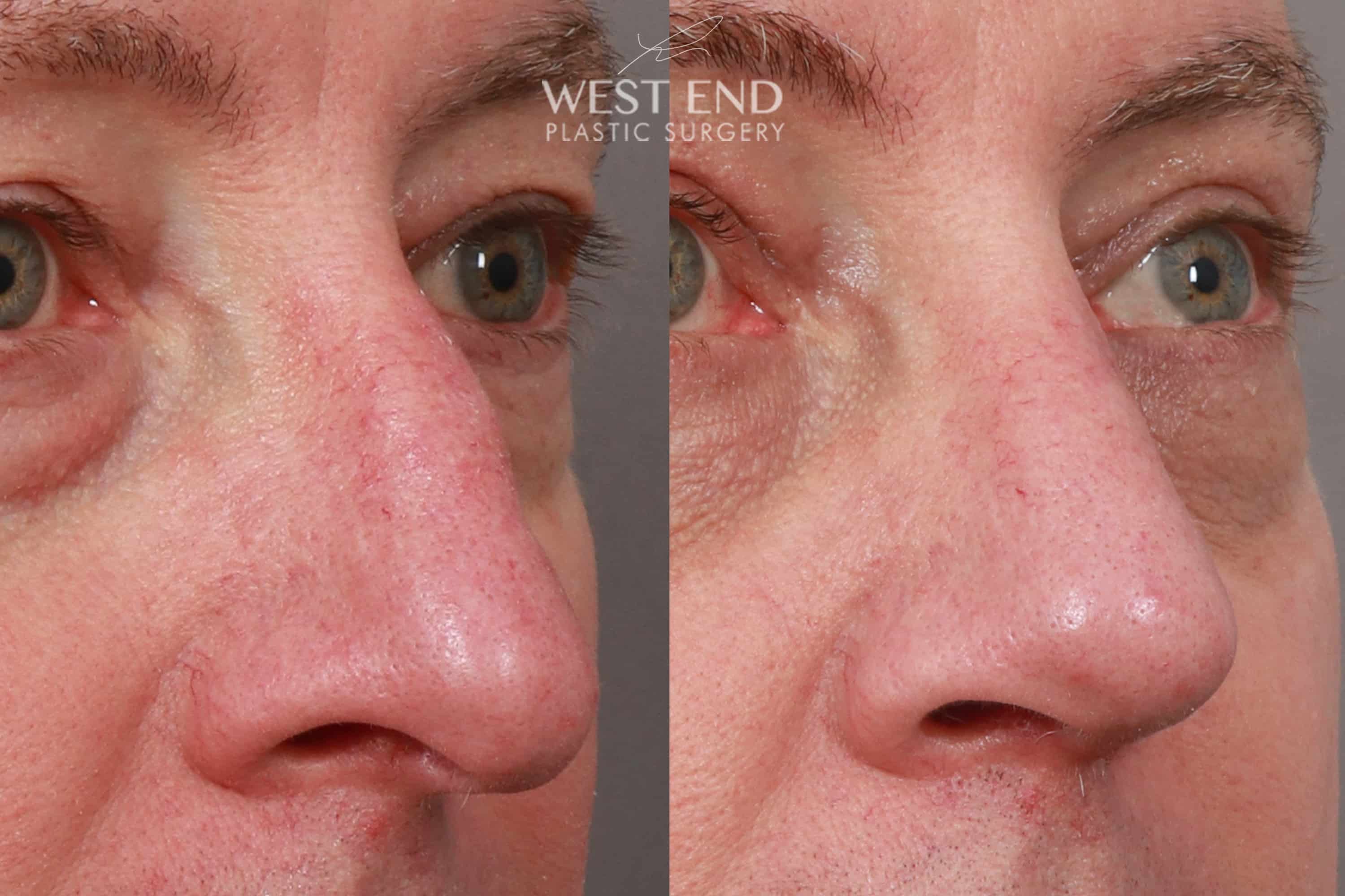 Open Septorhinoplasty with ClariFix (1 Month Post-Op) before photo. Individual results may vary.