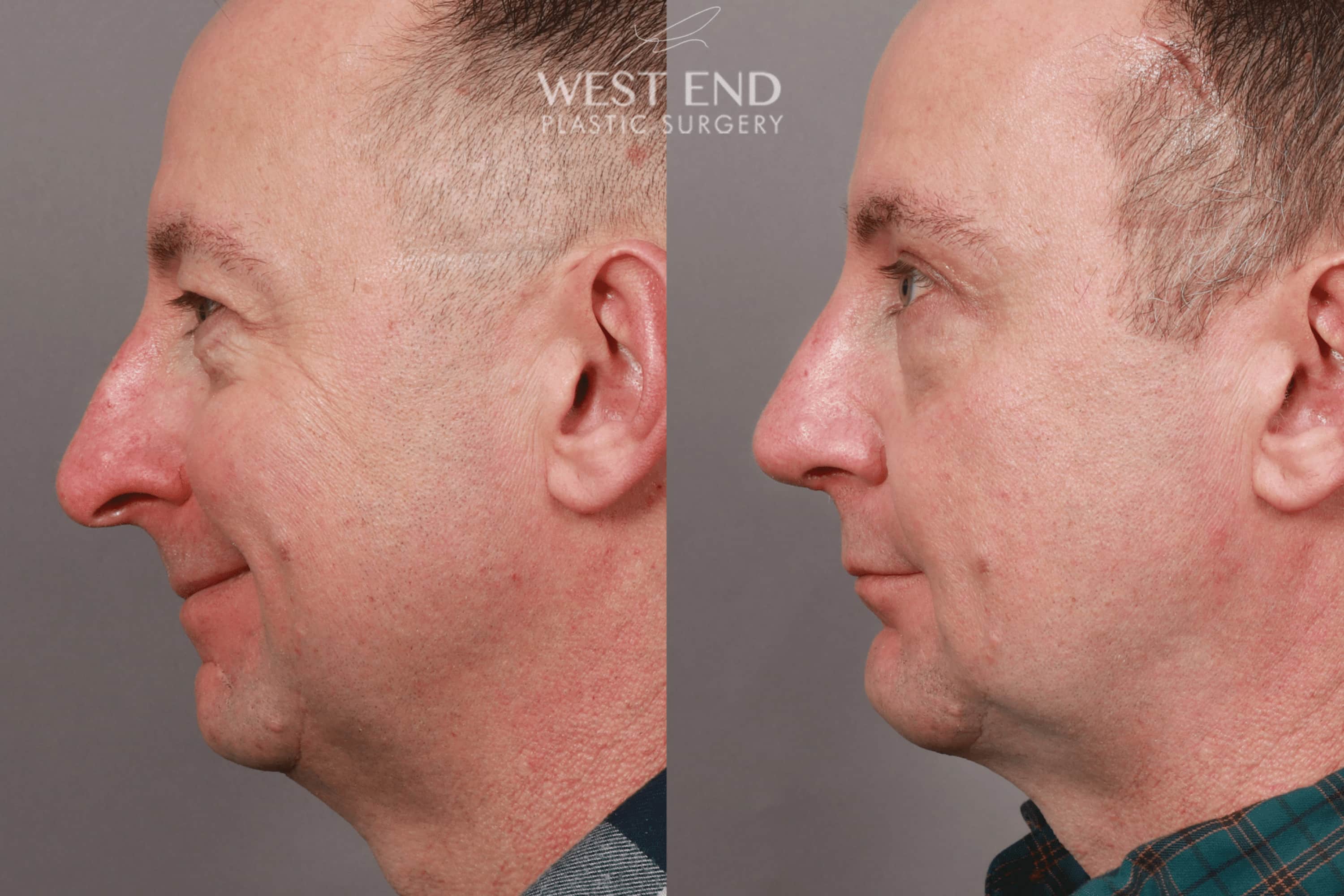 Open Septorhinoplasty with ClariFix (1 Month Post-Op) before photo. Individual results may vary.