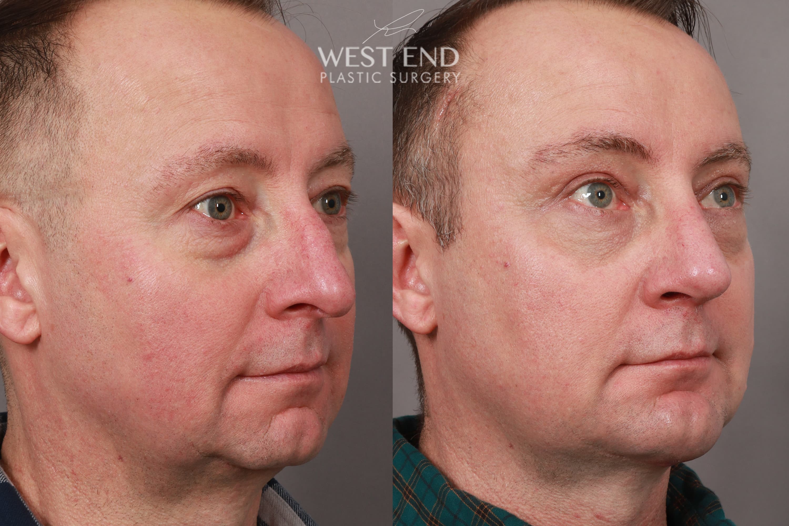 Open Septorhinoplasty with ClariFix (1 Month Post-Op) before photo. Individual results may vary.
