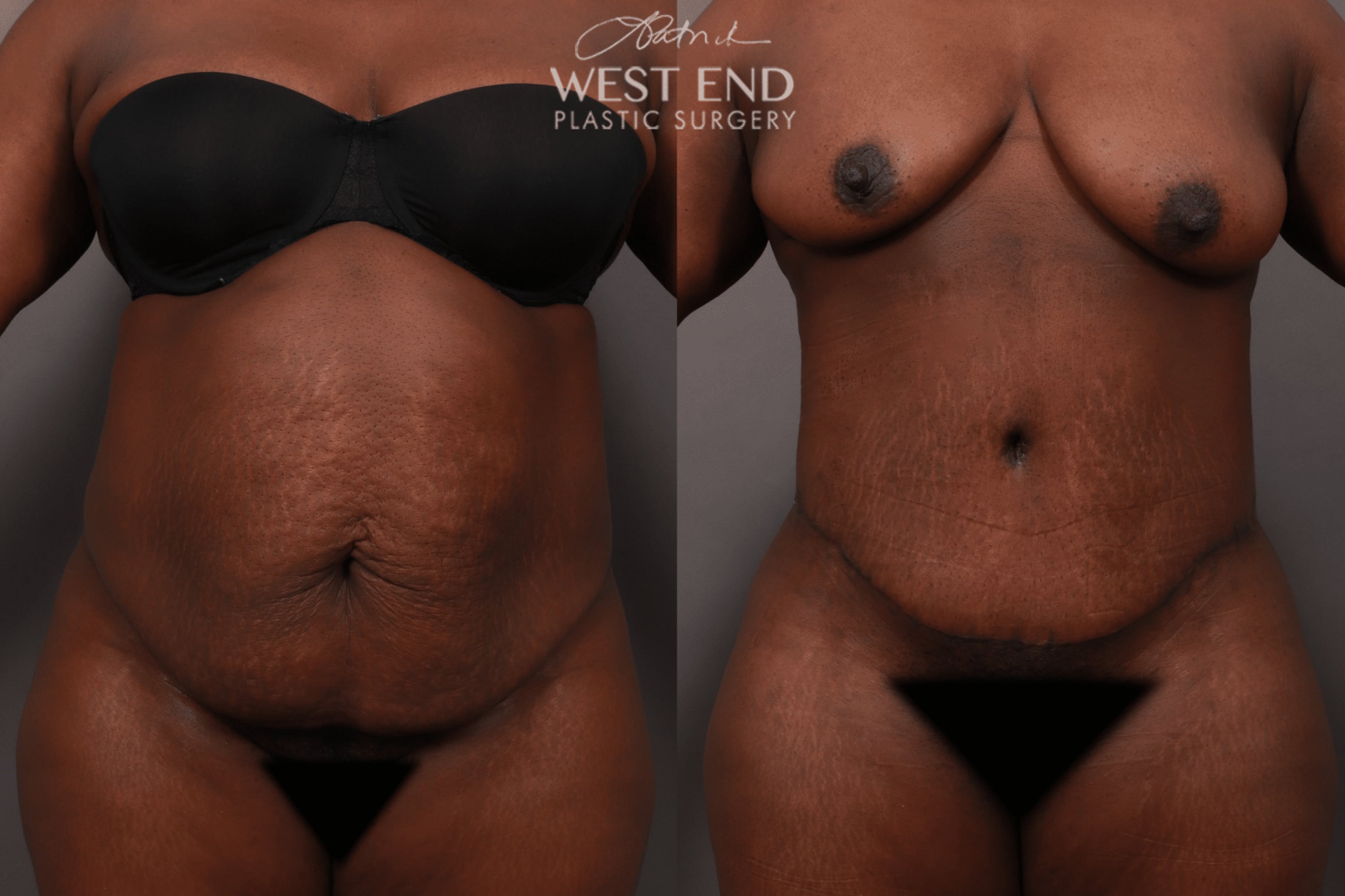 Tummy Tuck with Liposuction (5.5 Months Post-Op)