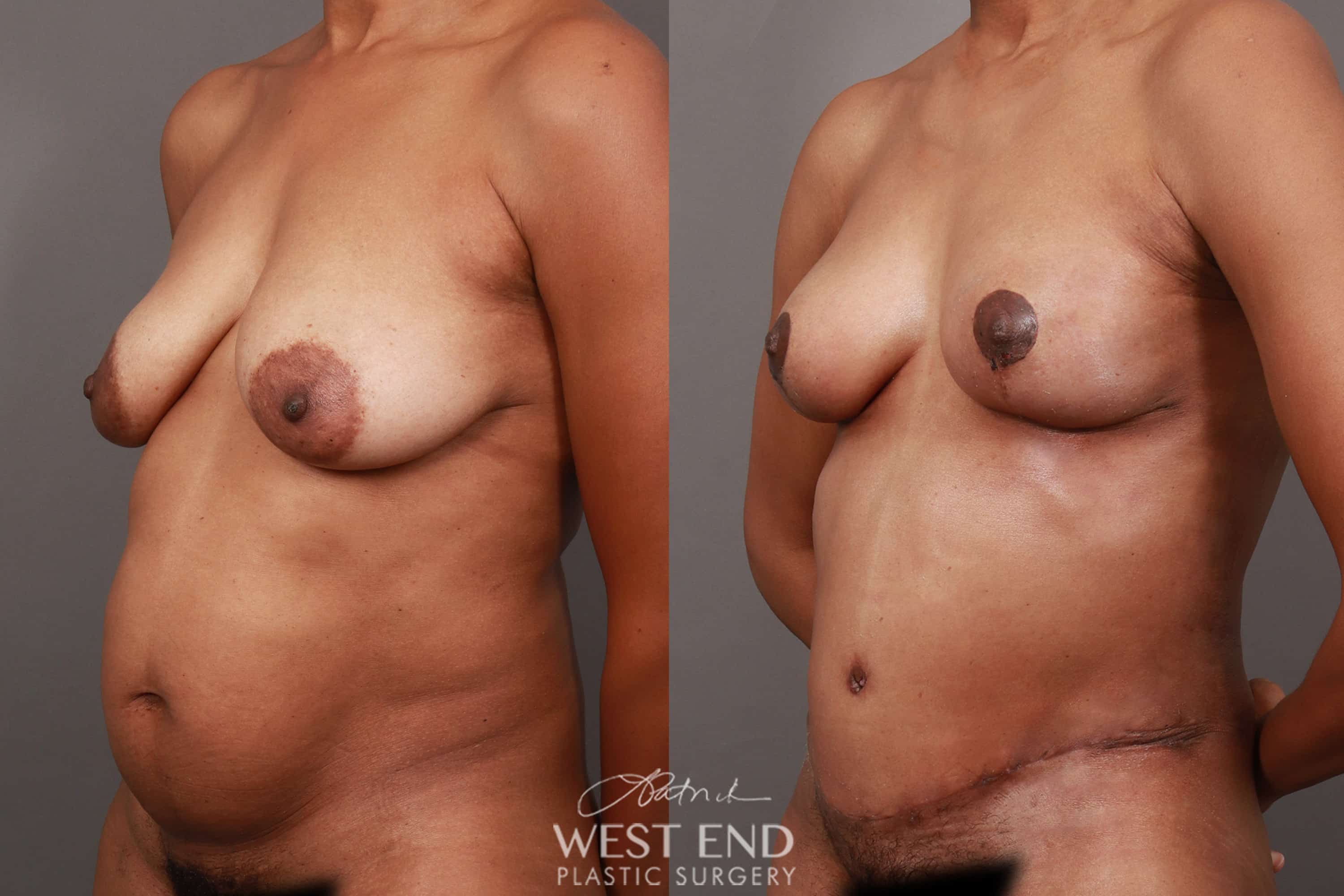 Breast Lift (1 Month Post-Op)