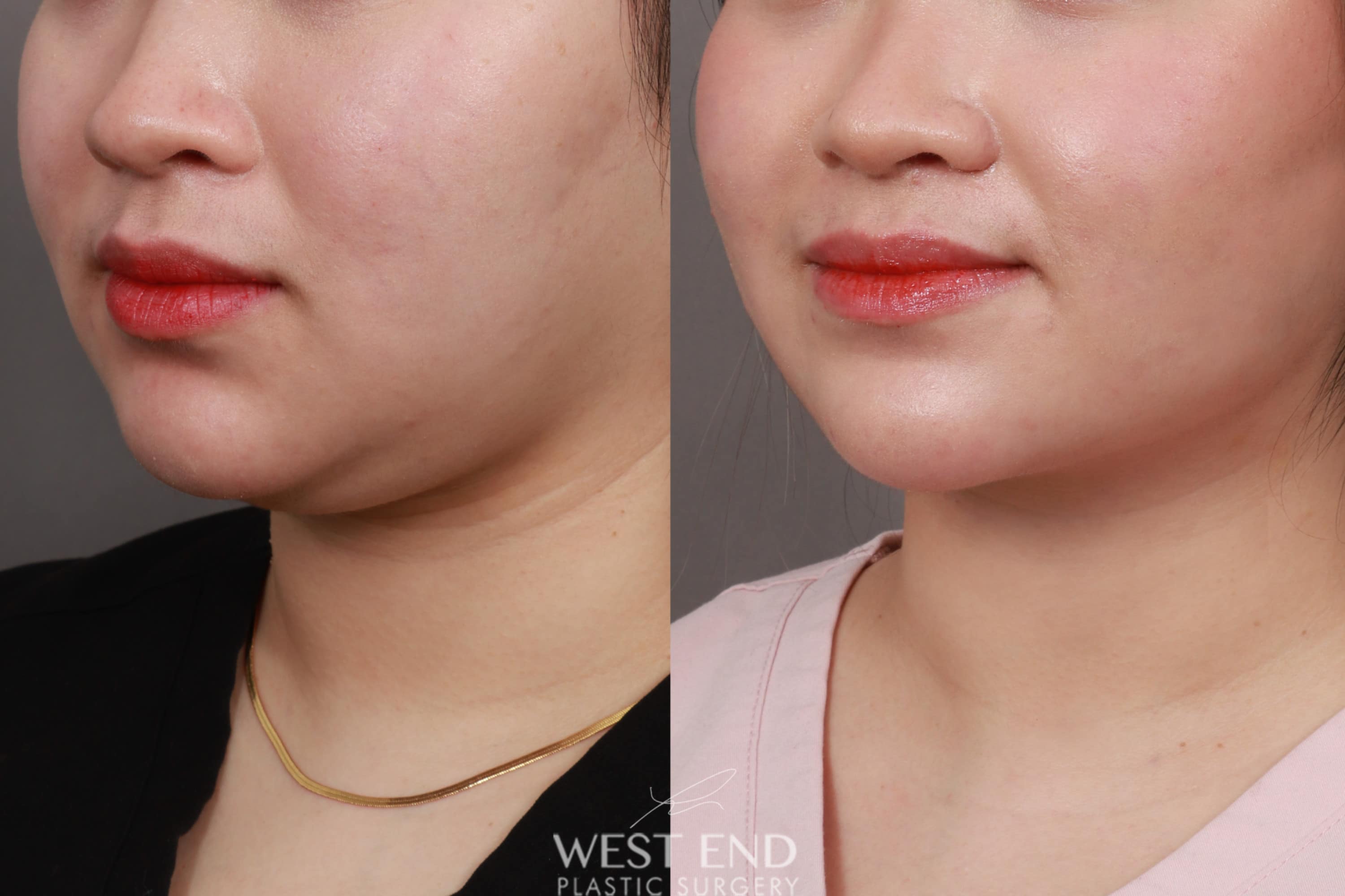 Liposuction of the Submental, Jawline, and Neck Region (2 Weeks Post-Op)