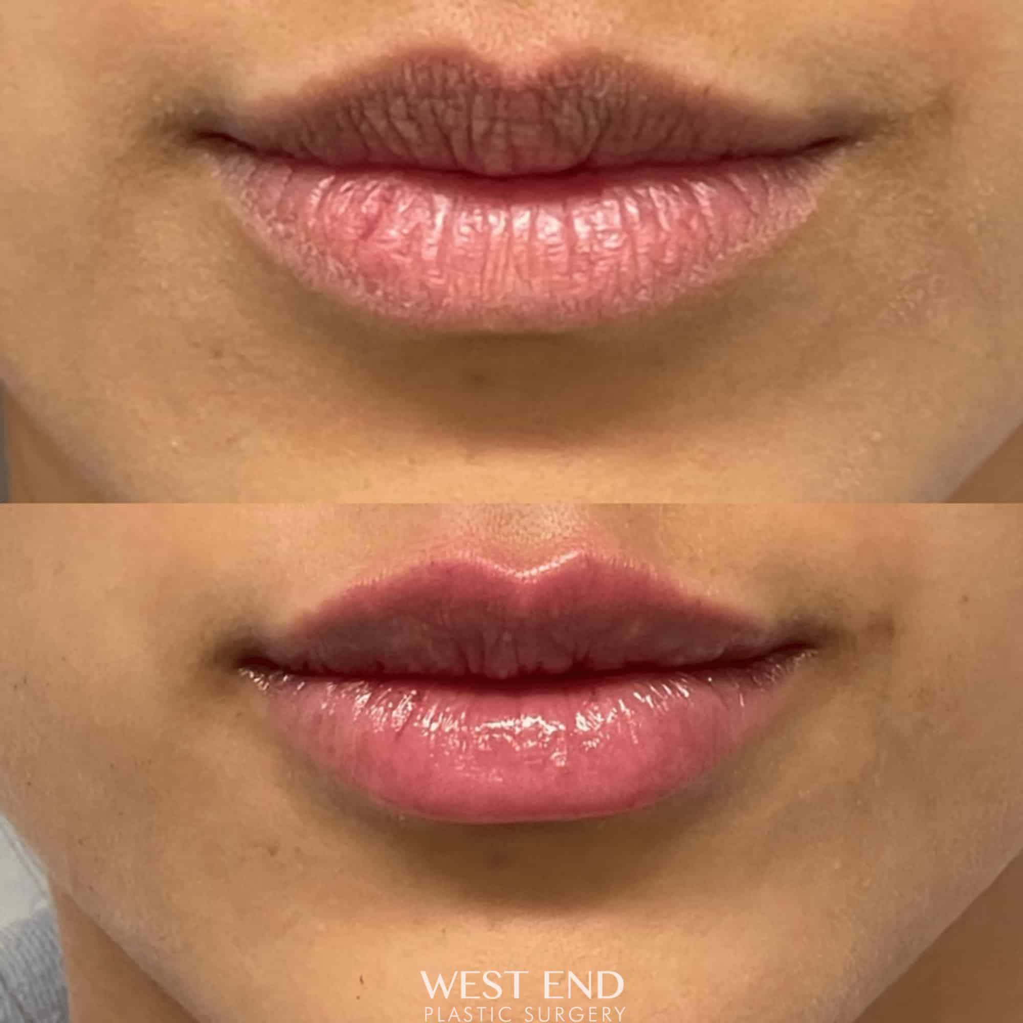 Lip Filler