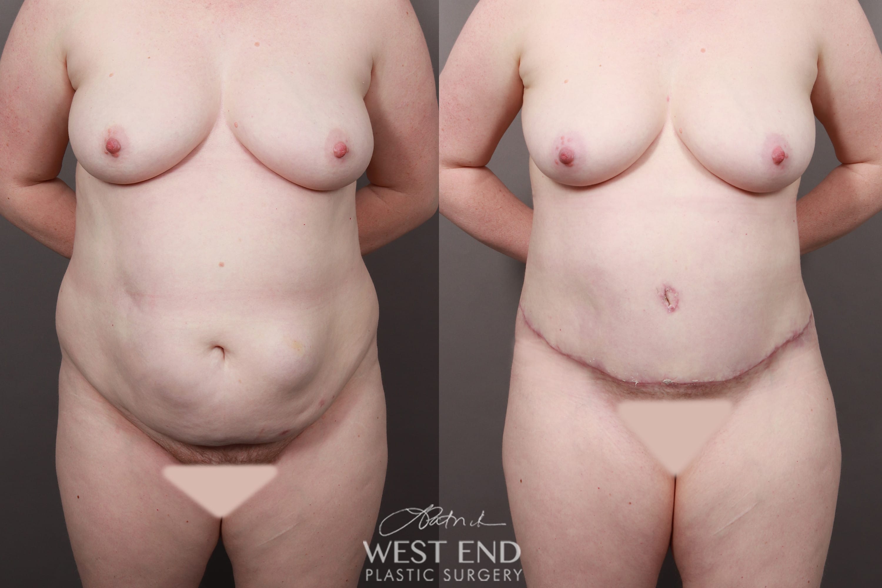 Tummy Tuck with Liposuction (1 Month Post-Op)