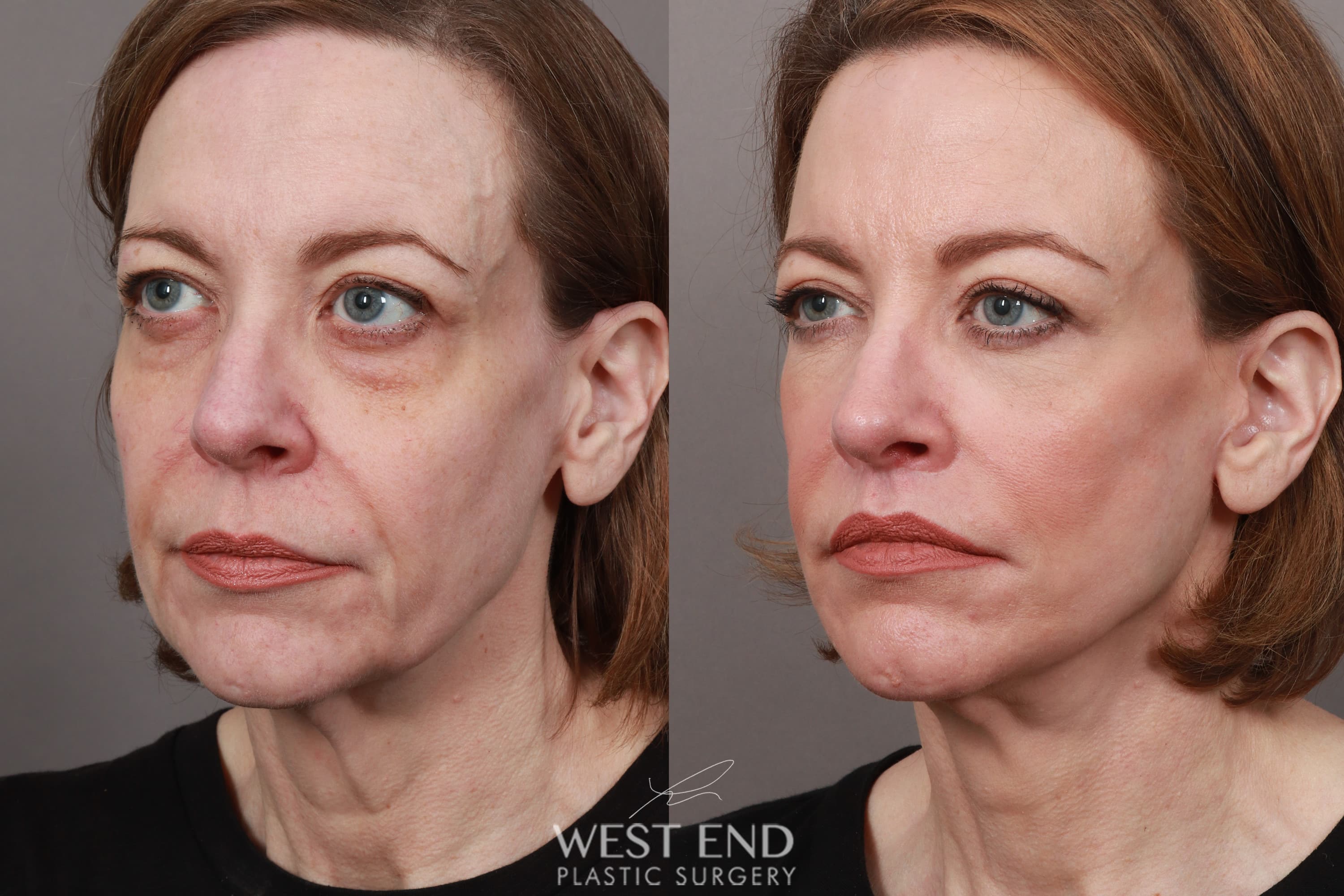 Deep Plane Facelift & Neck Lift, Lip Lift, Eyelid Lift, Brow Lift, Fat Grafting, and CO2 Resurfacing (3.5 Months Post-Op) before photo. Individual results may vary.