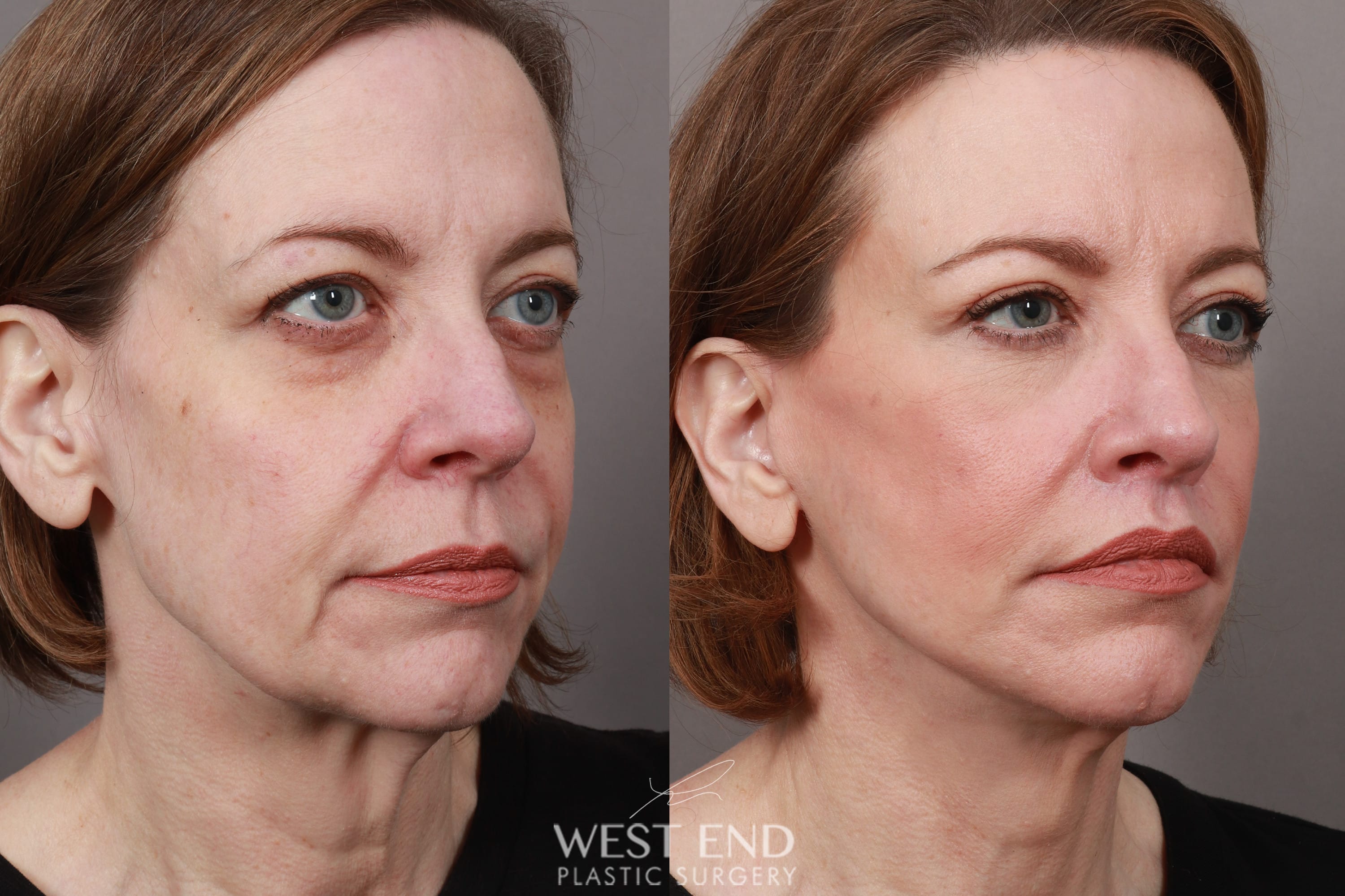 Deep Plane Facelift & Neck Lift, Lip Lift, Eyelid Lift, Brow Lift, Fat Grafting, and CO2 Resurfacing (3.5 Months Post-Op) before photo. Individual results may vary.