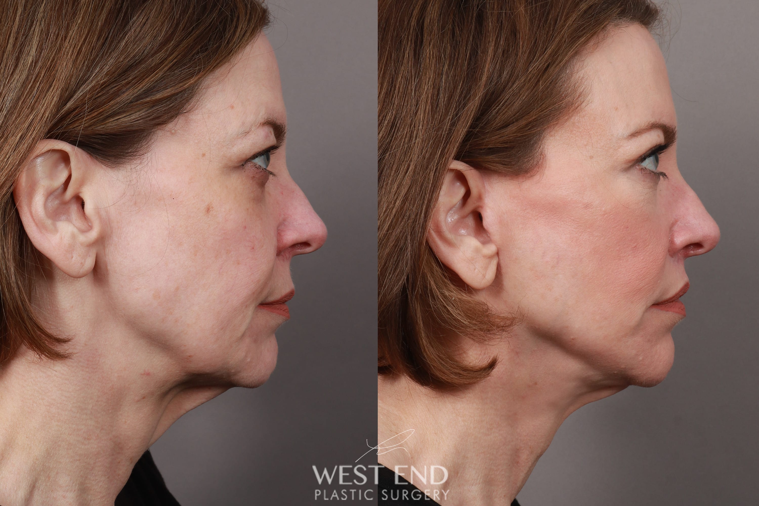 Deep Plane Facelift & Neck Lift, Lip Lift, Eyelid Lift, Brow Lift, Fat Grafting, and CO2 Resurfacing (3.5 Months Post-Op) before photo. Individual results may vary.
