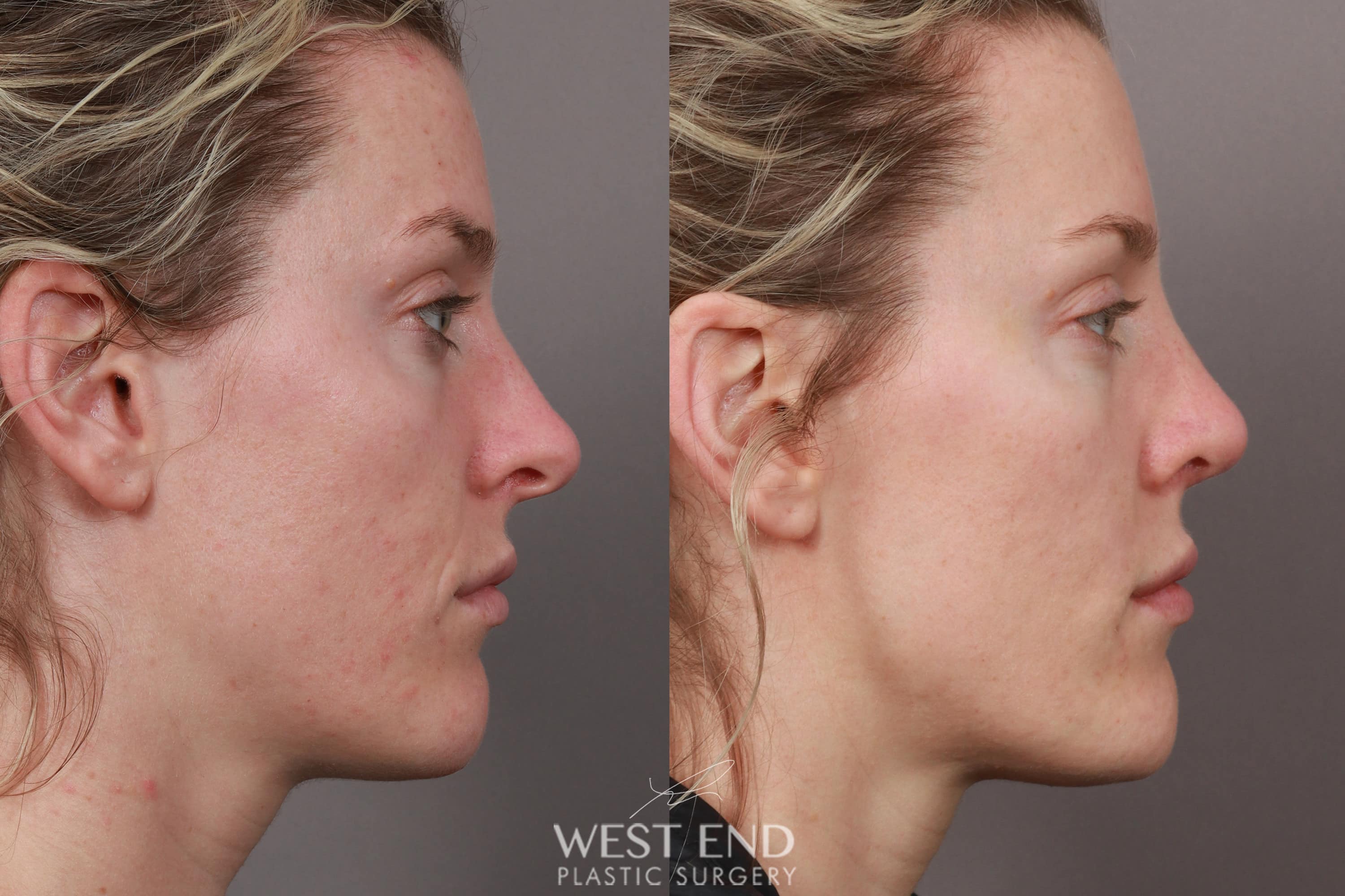 Rhinoplasty (4.5 Months Post-Op) before photo. Individual results may vary.