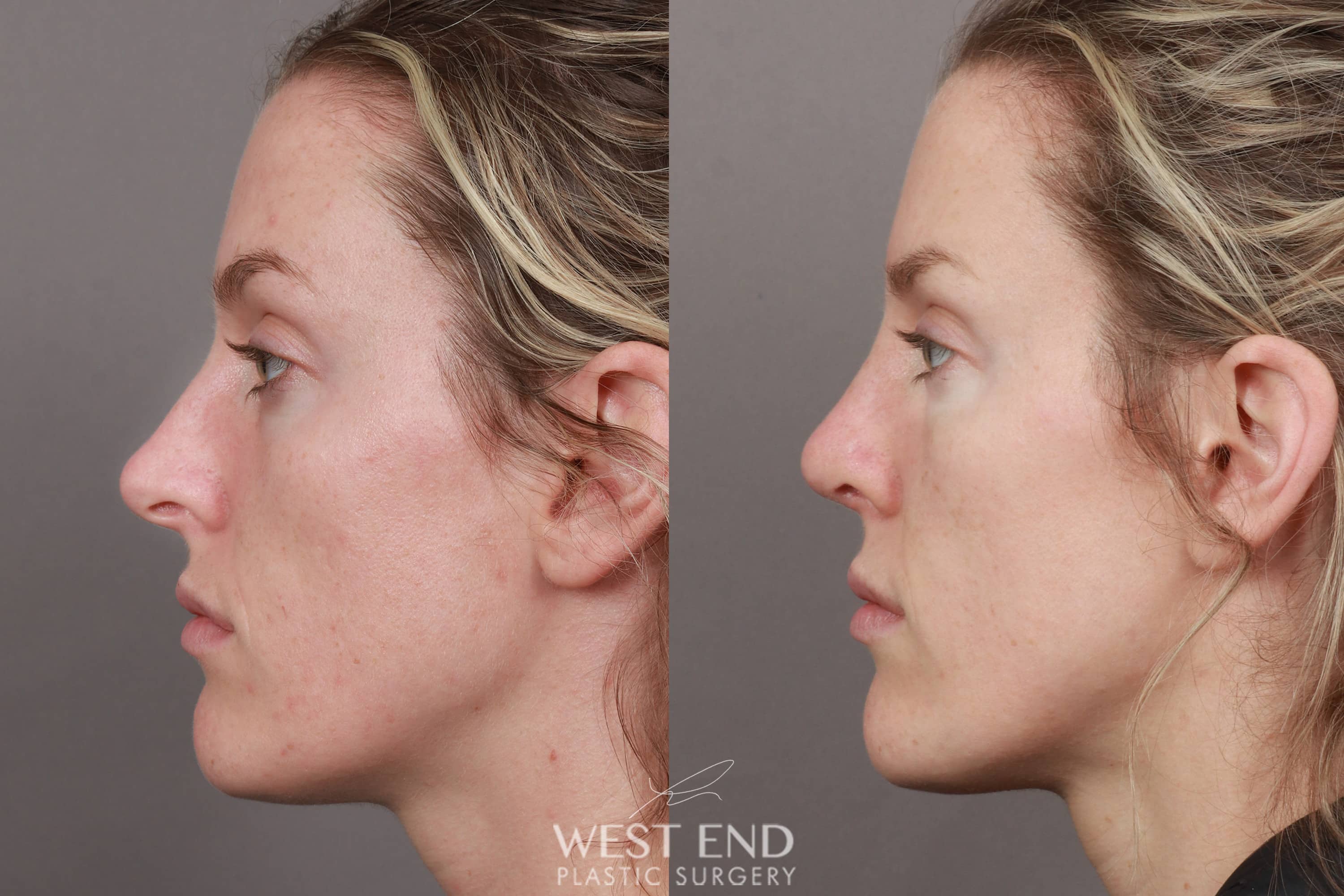 Rhinoplasty (4.5 Months Post-Op) before photo. Individual results may vary.