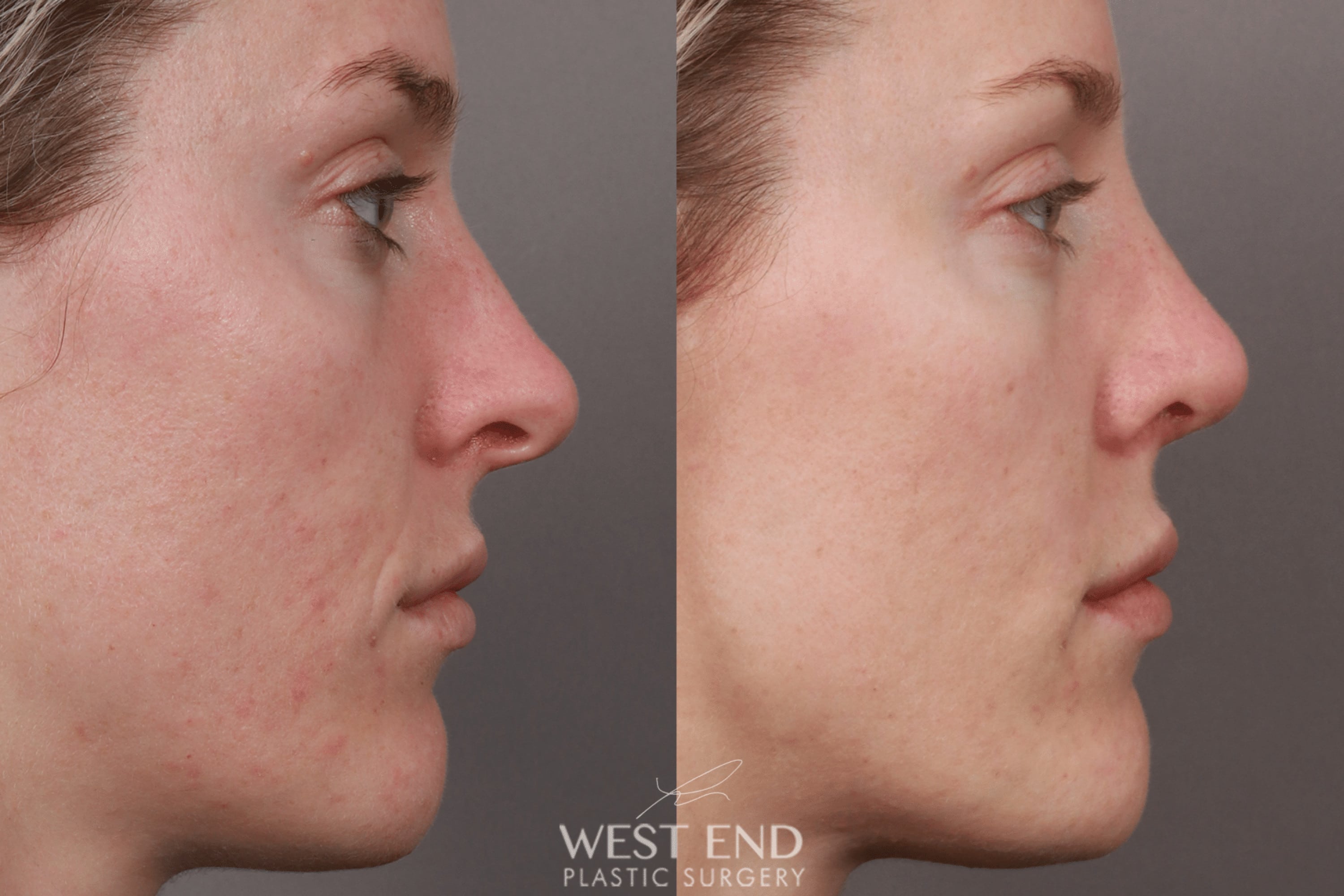 Rhinoplasty (4.5 Months Post-Op) before photo. Individual results may vary.