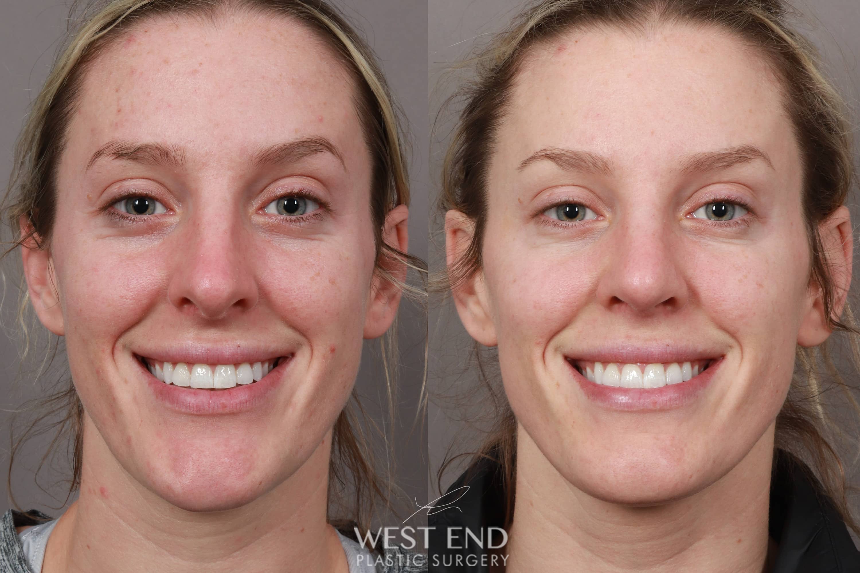 Rhinoplasty (4.5 Months Post-Op) before photo. Individual results may vary.