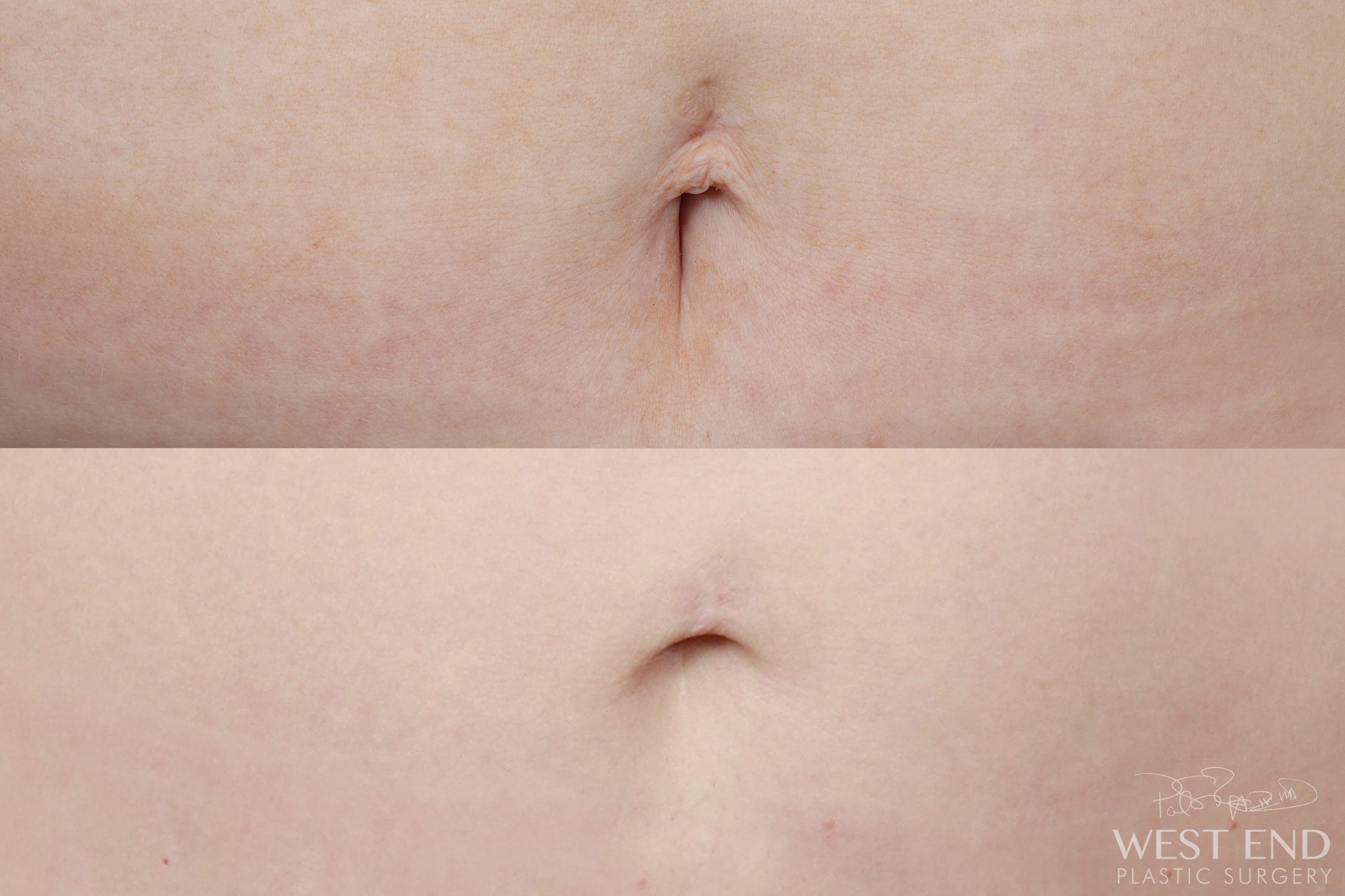 Umbilicoplasty (Fat Grafting to Belly Button)