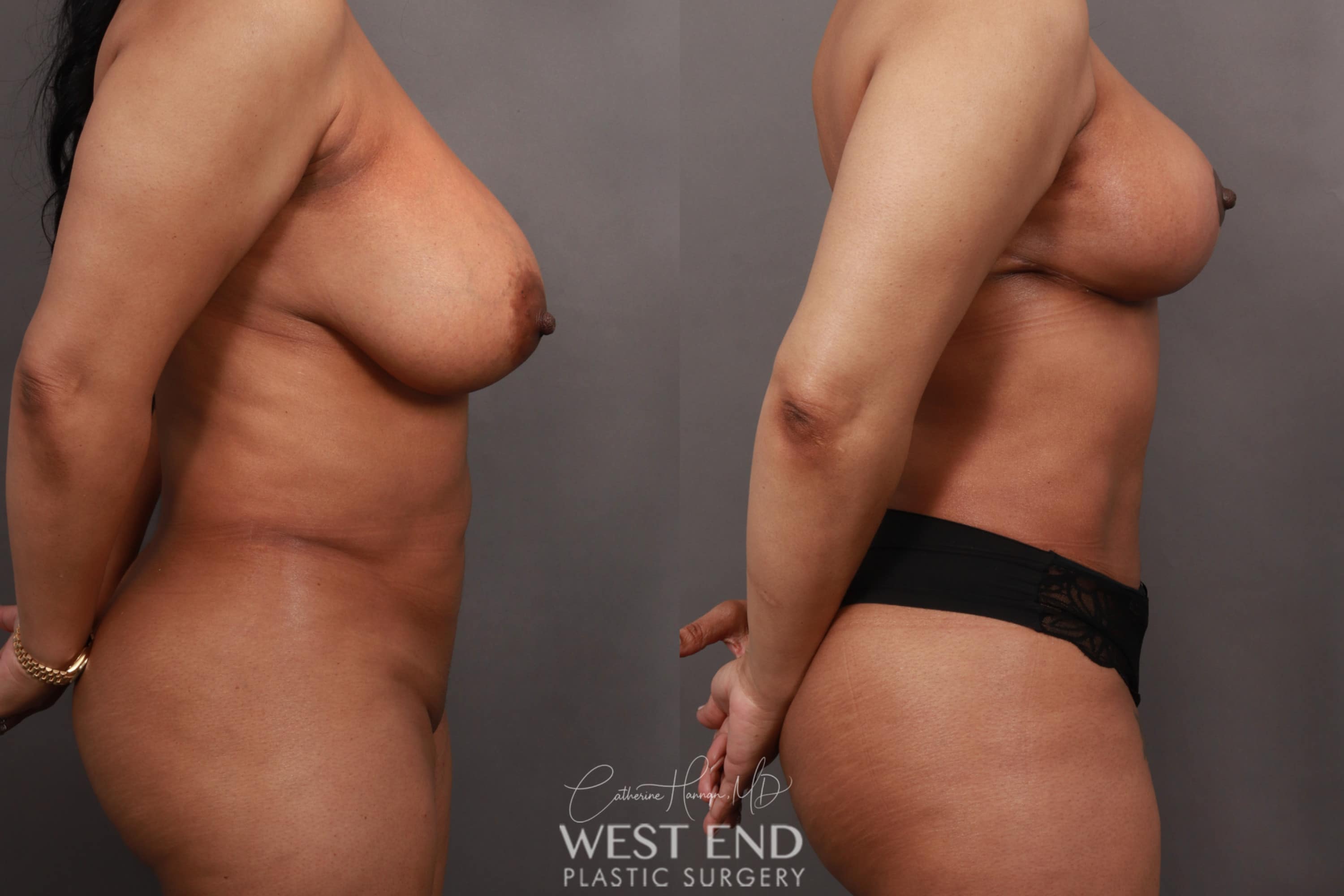 Breast Reduction with a Reverse Abdominal Lift & Liposuction (2 Months Post-Op)