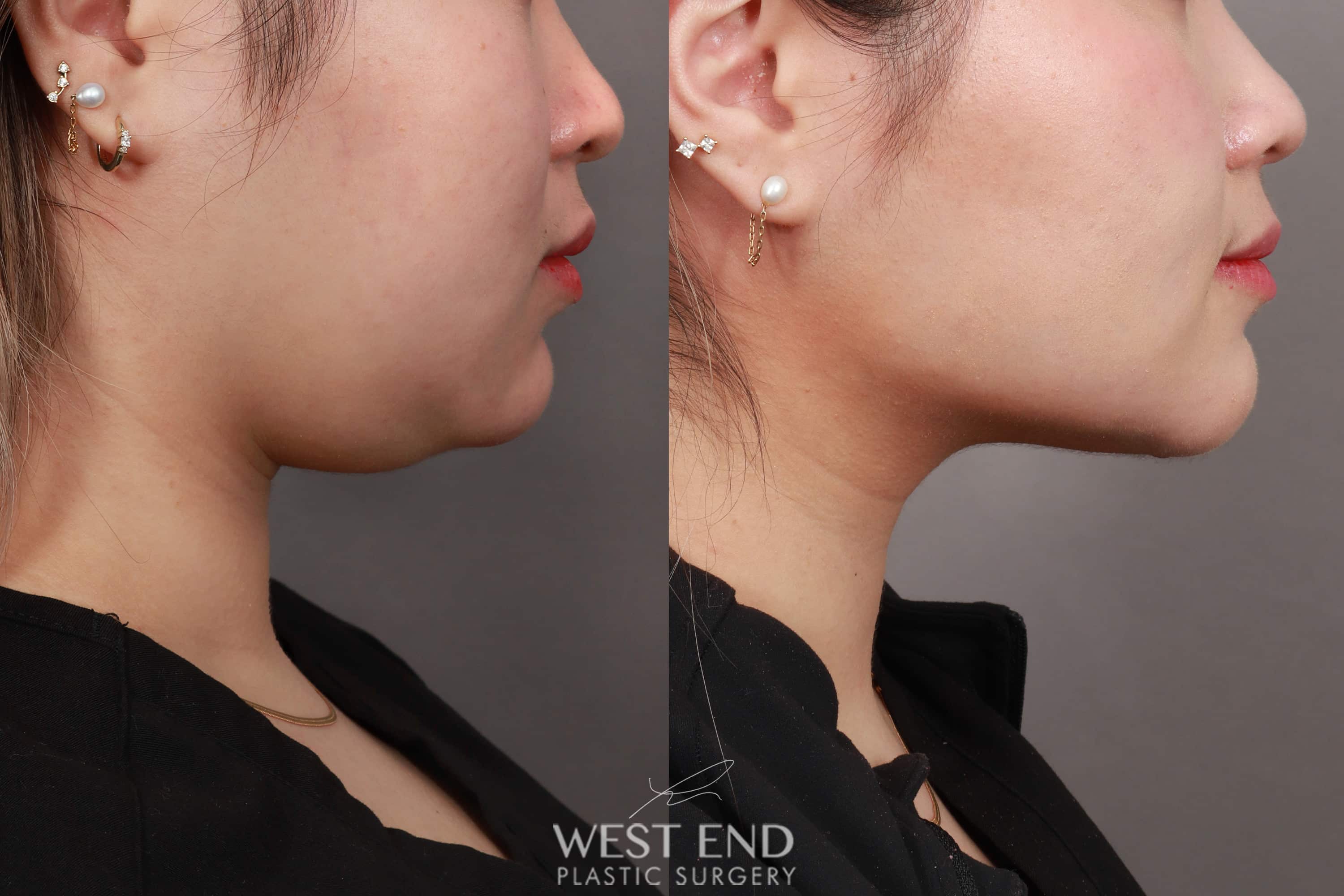 Liposuction of the Submental, Jawline, and Neck Region (3 Months Post-Op) before photo. Individual results may vary.