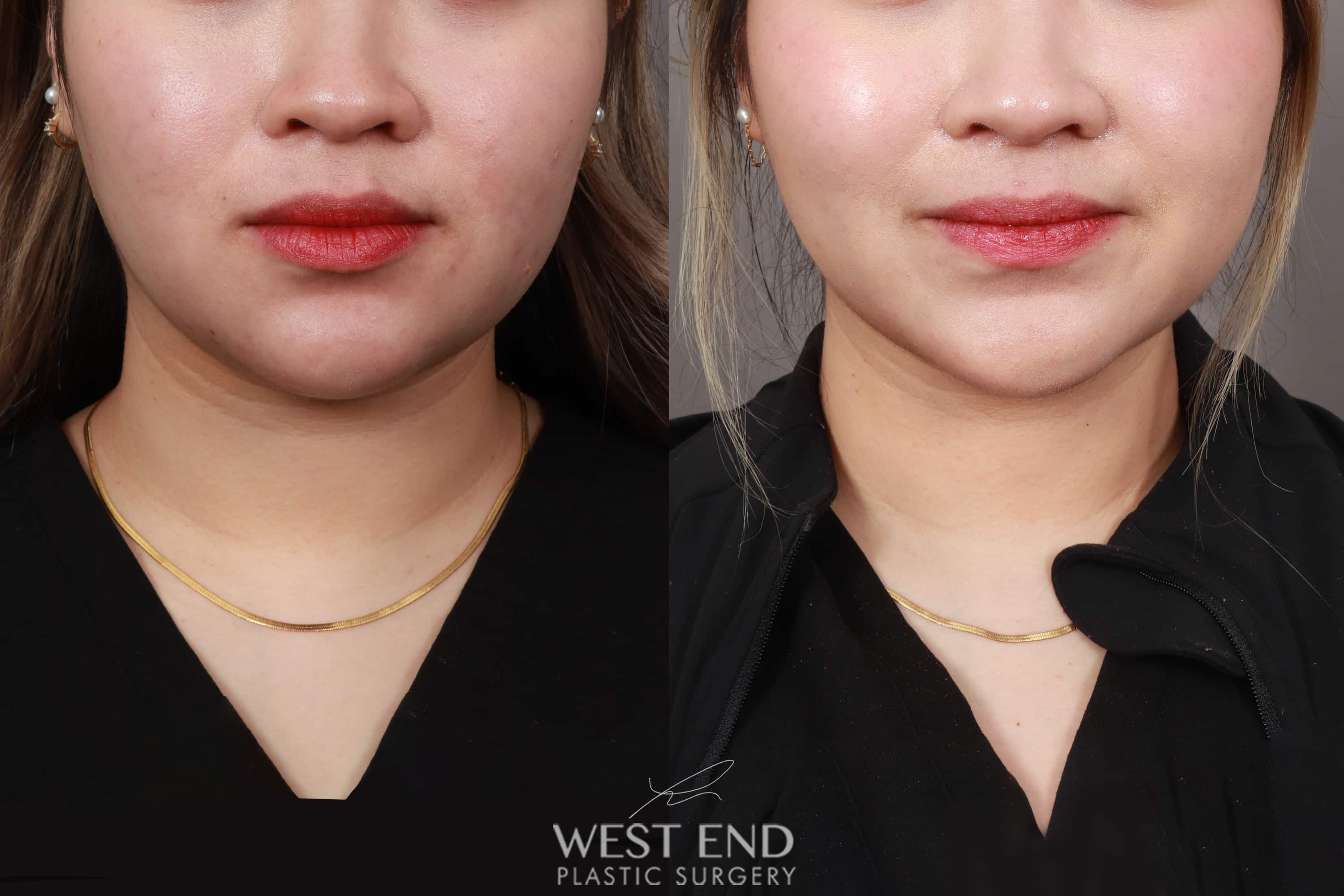 Liposuction of the Submental, Jawline, and Neck Region (3 Months Post-Op) before photo. Individual results may vary.