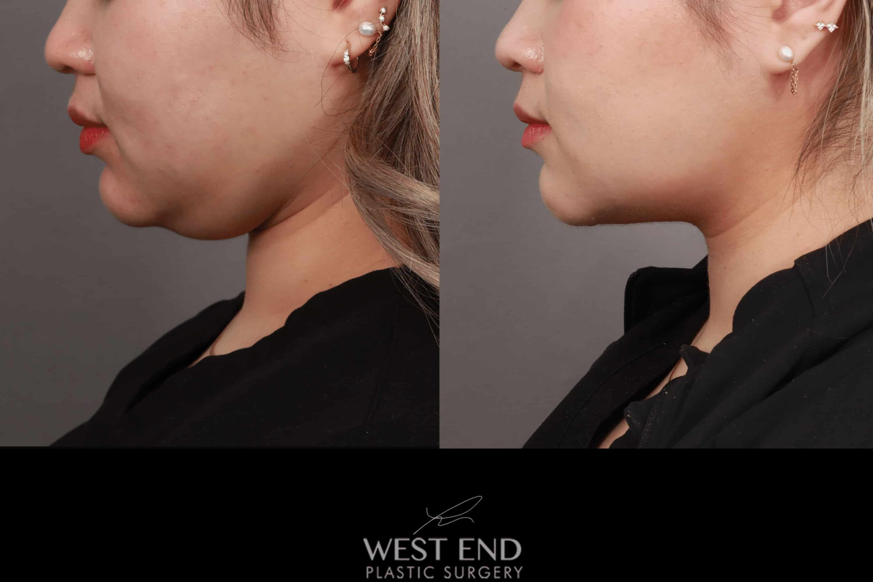 Liposuction of the Submental, Jawline, and Neck Region (3 Months Post-Op) before photo. Individual results may vary.