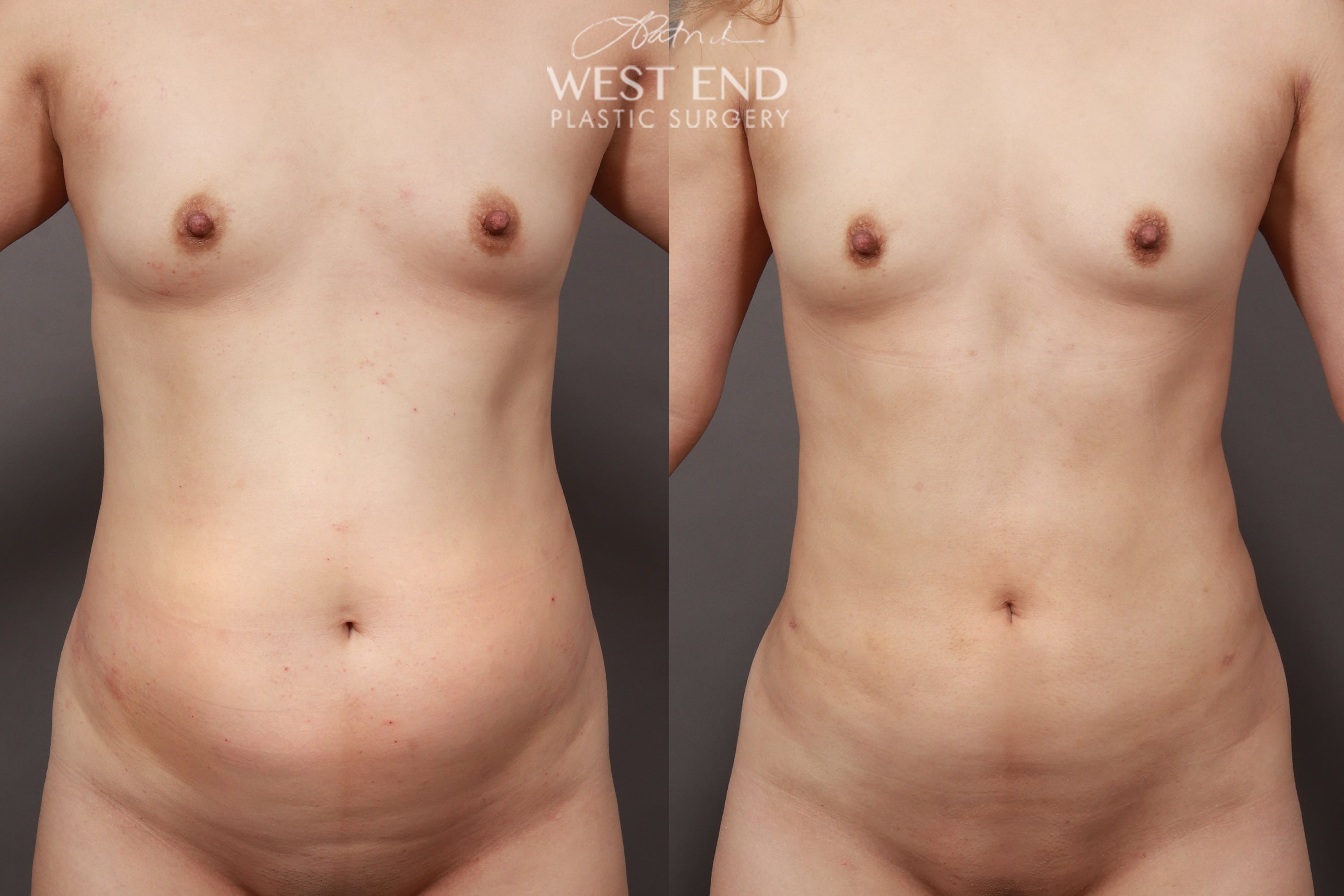 Liposuction and Renuvion Skin Tightening (3 Weeks Post-Op)