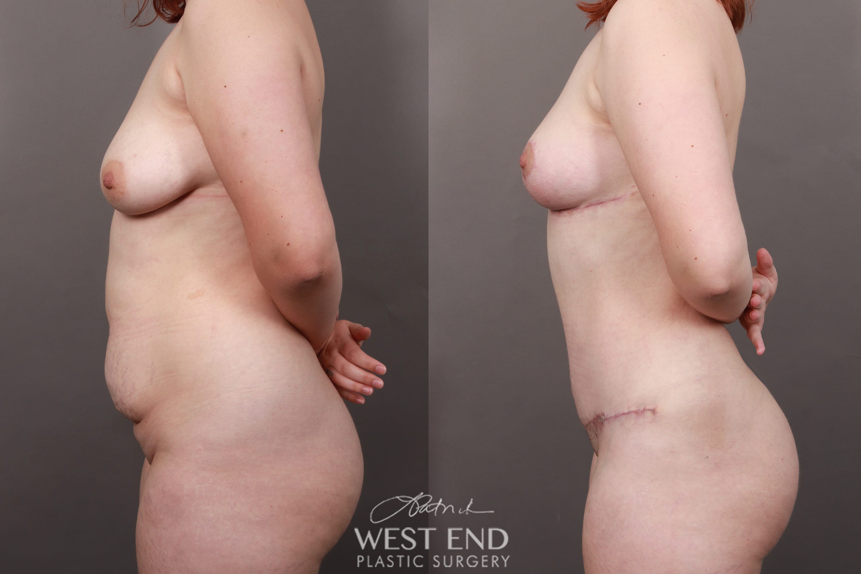 Mommy Makeover (Tummy Tuck, Breast Lift with Fat Grafting, and Liposuction) 2 Months Post-Op