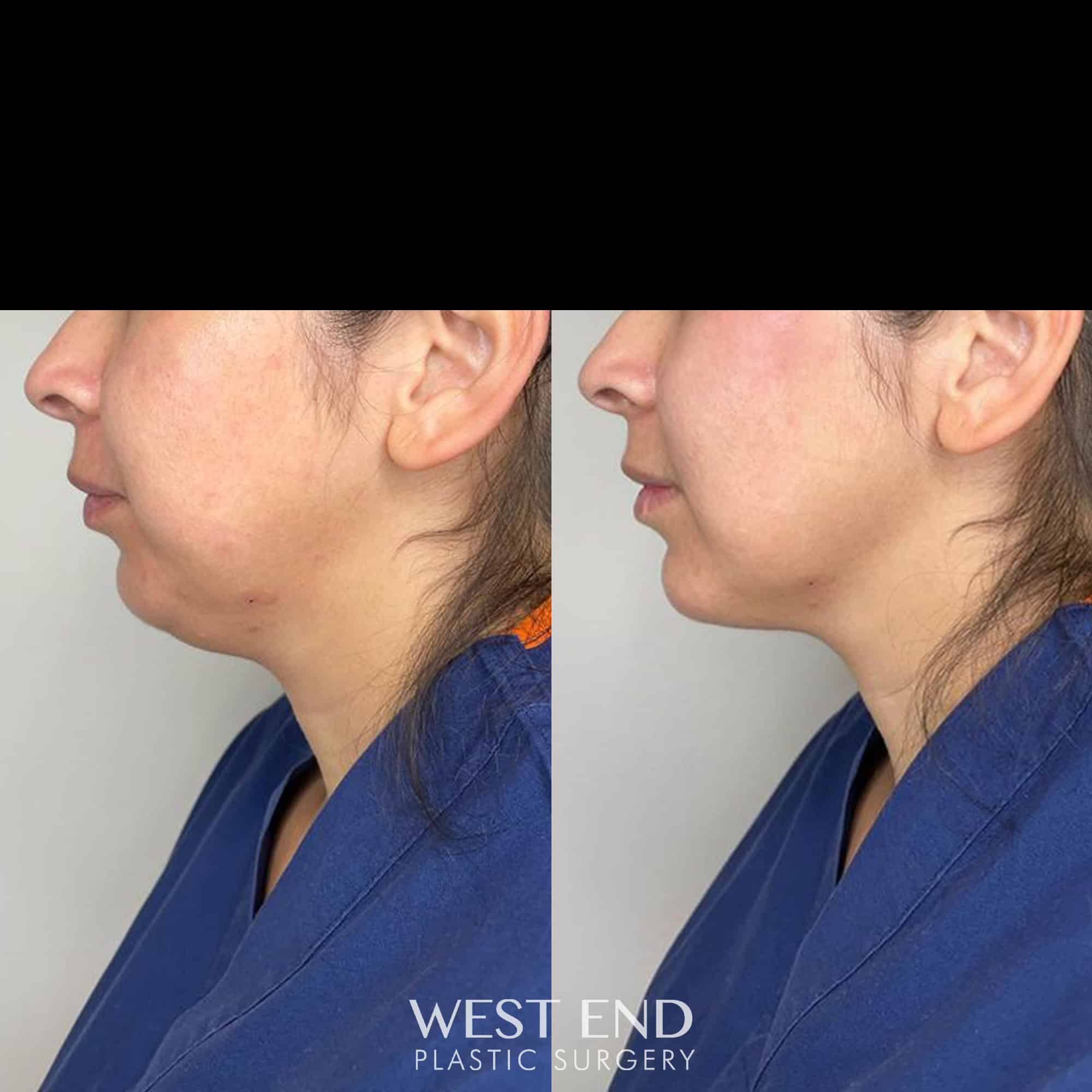 Chin Filler