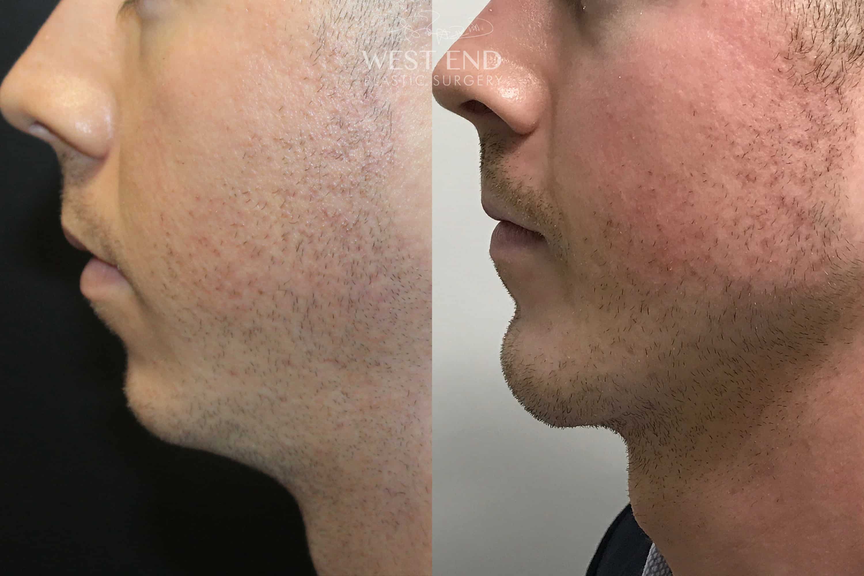 Chin & Mandible (Jaw) Implants (2 Weeks Post-op) before photo. Individual results may vary.