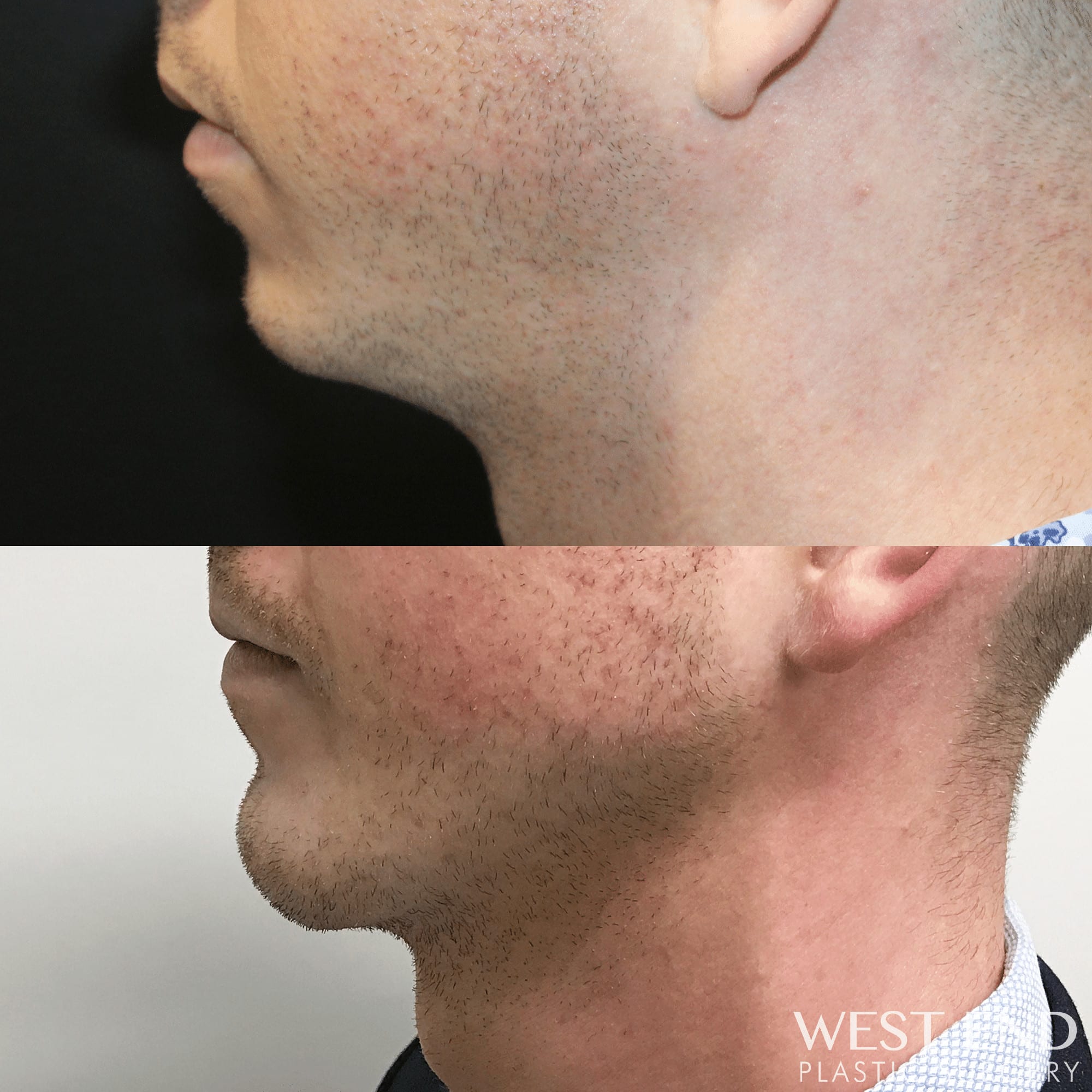 Chin & Mandible (Jaw) Implants (2 Weeks Post-op) before photo. Individual results may vary.