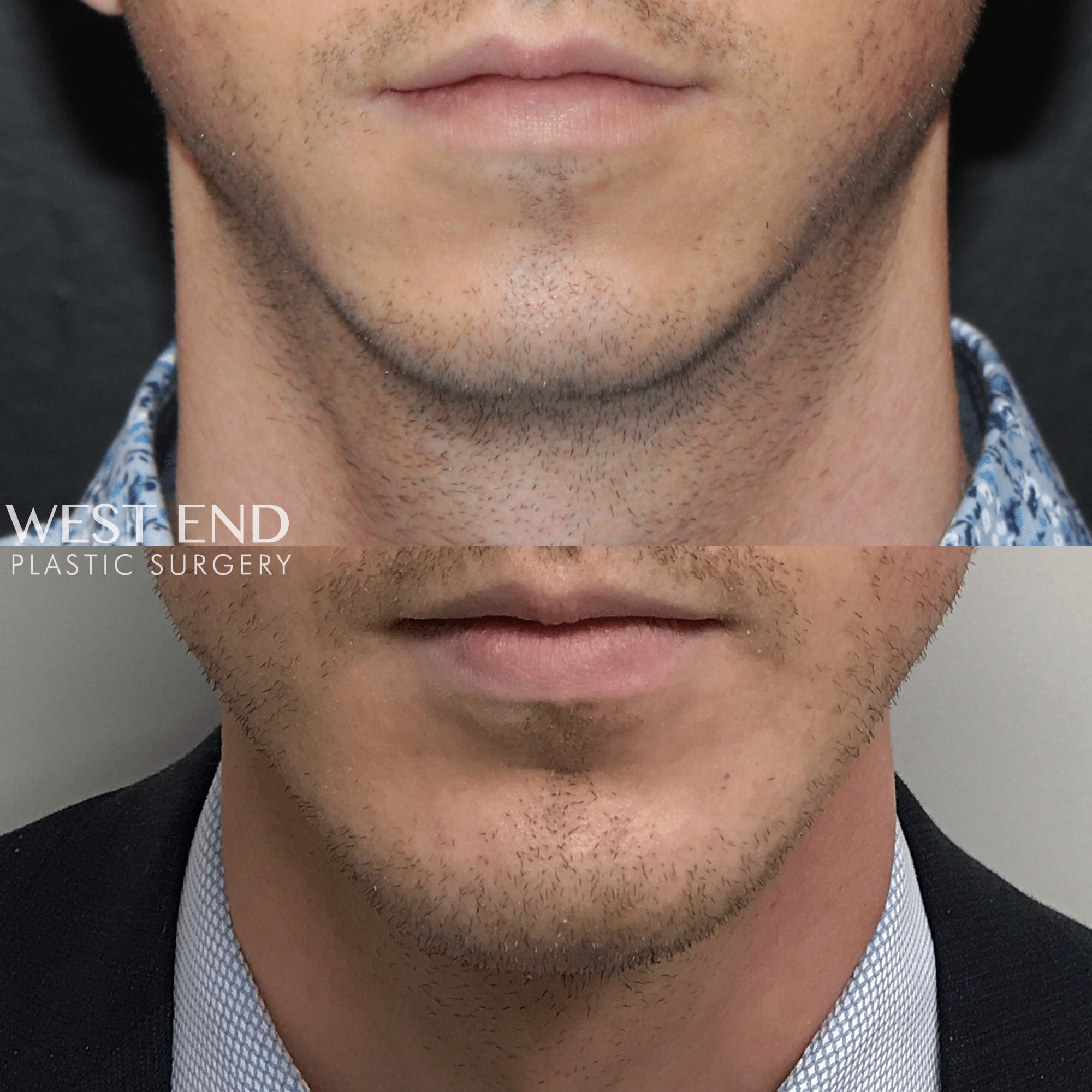 Chin & Mandible (Jaw) Implants (2 Weeks Post-op) before photo. Individual results may vary.