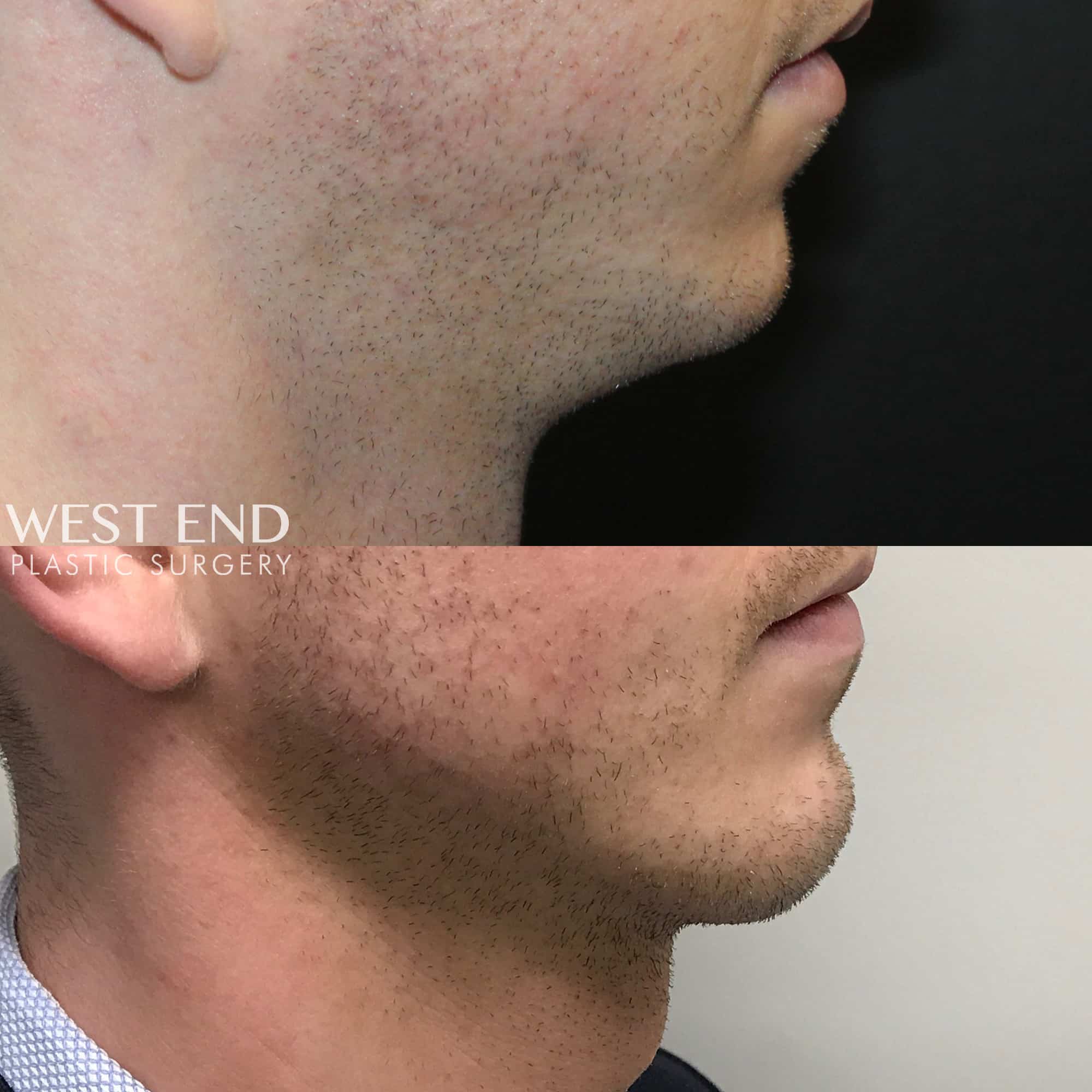Chin & Mandible (Jaw) Implants (2 Weeks Post-op) before photo. Individual results may vary.