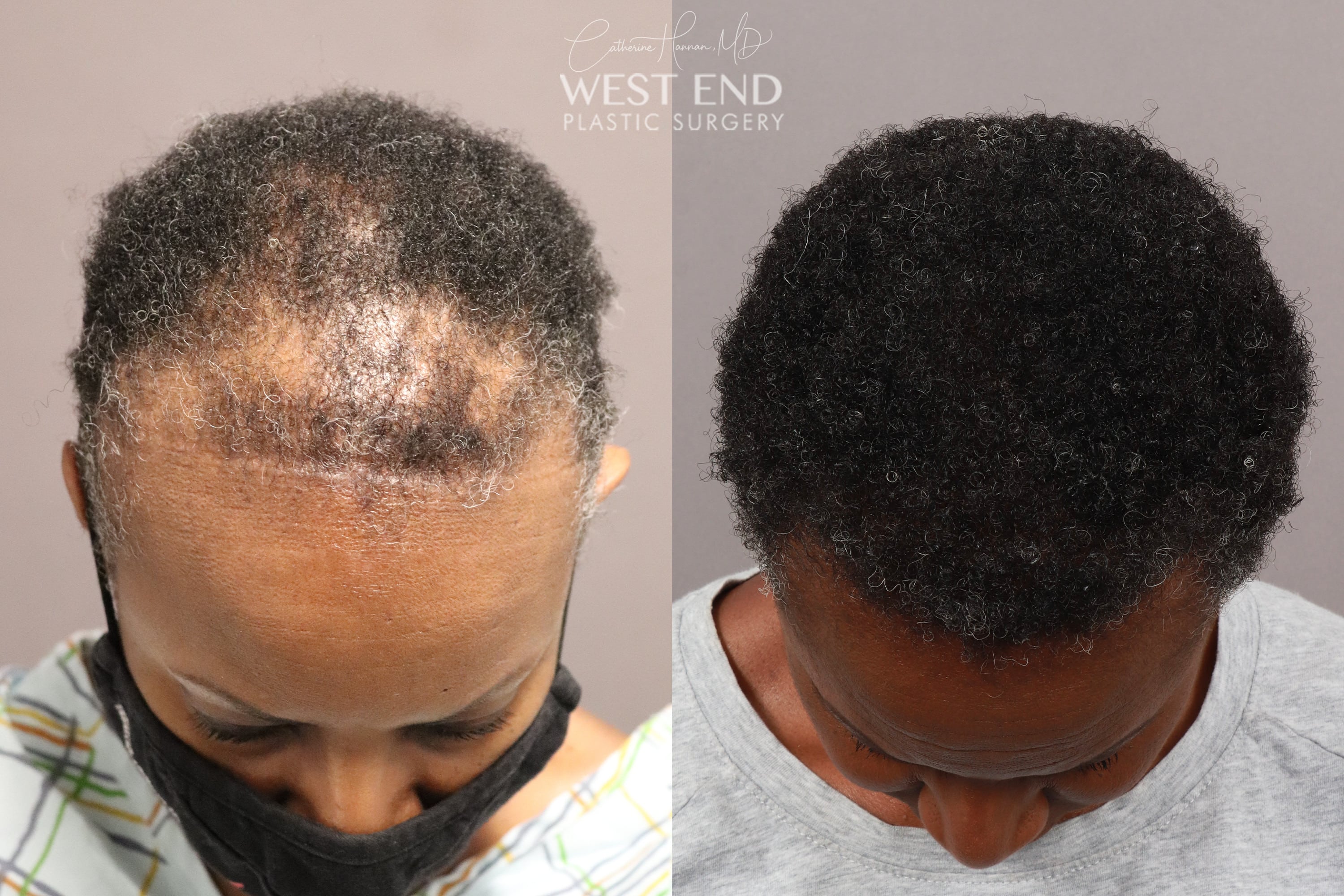 NeoGraft Hair Restoration (1 Year Post-op) before photo. Individual results may vary.