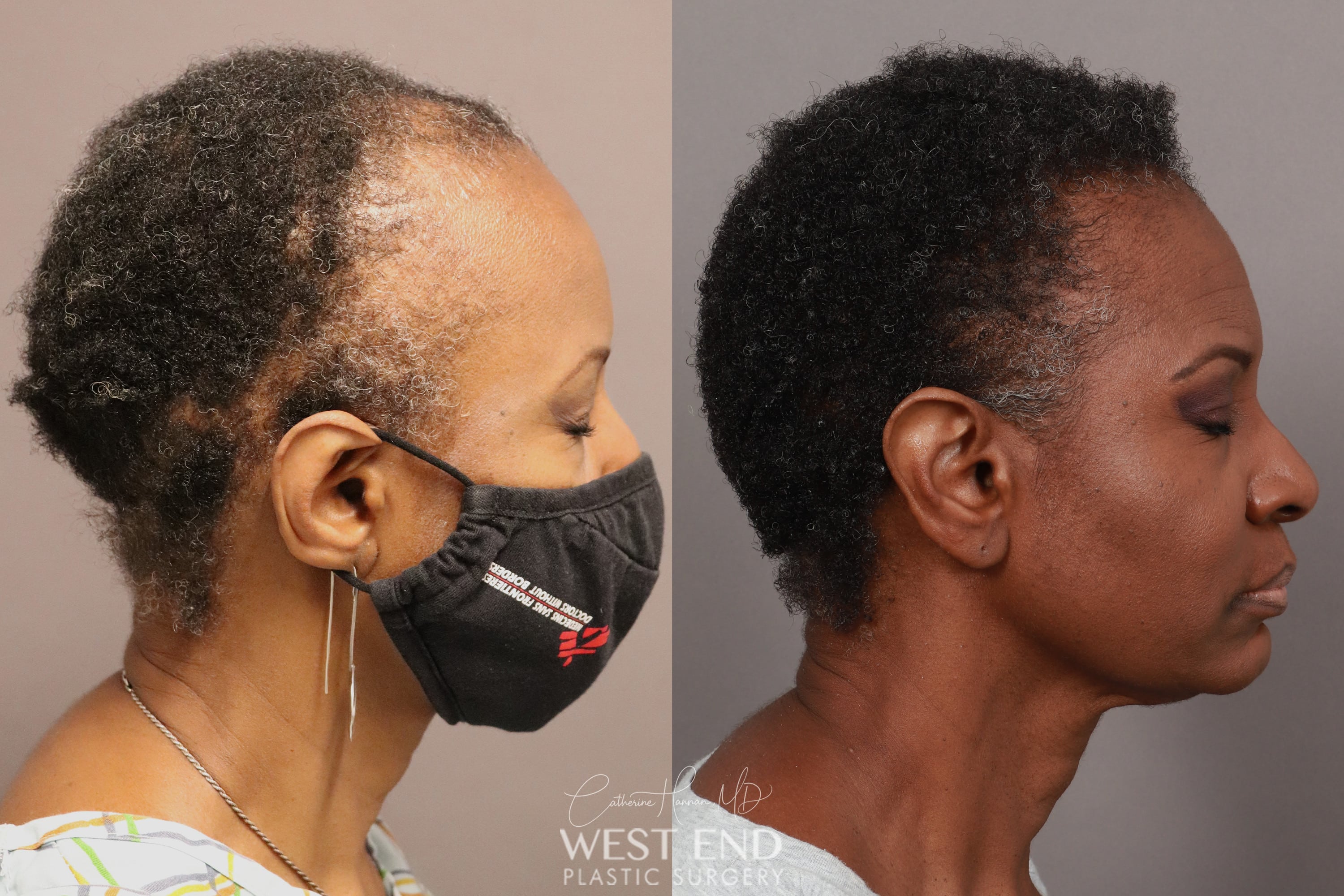 NeoGraft Hair Restoration (1 Year Post-op) before photo. Individual results may vary.