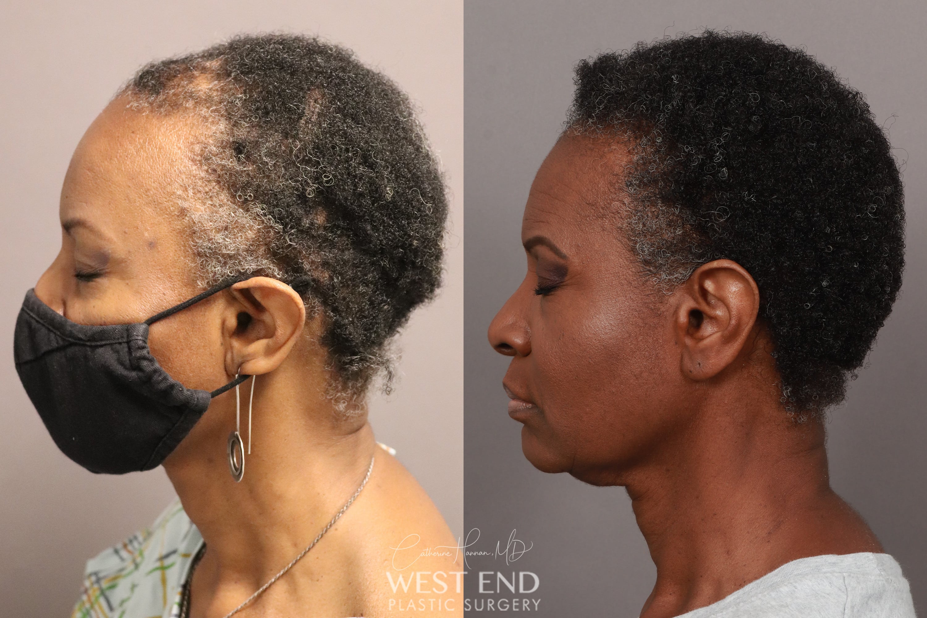 NeoGraft Hair Restoration (1 Year Post-op) before photo. Individual results may vary.