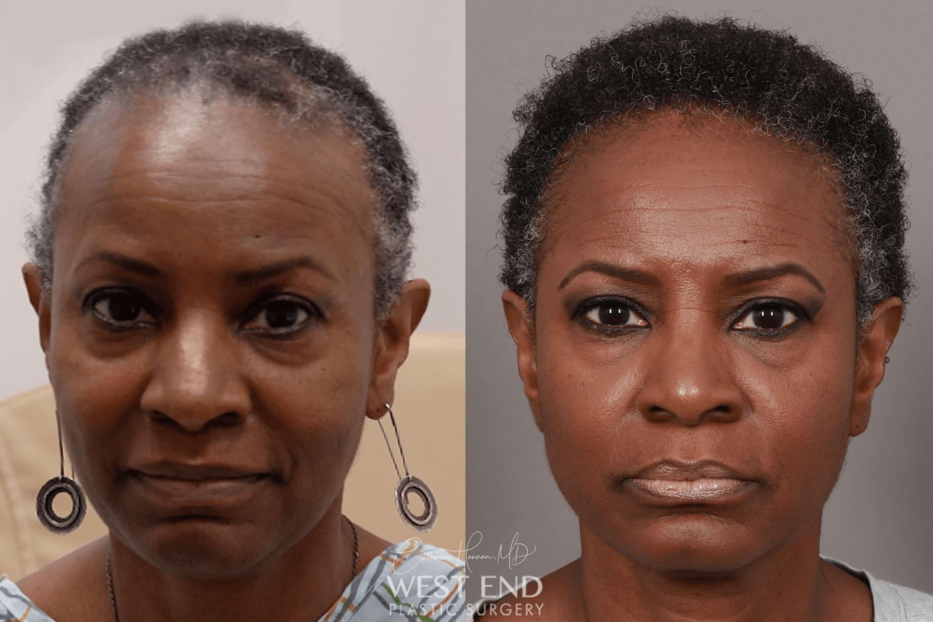 NeoGraft Hair Restoration (1 Year Post-op) before photo. Individual results may vary.