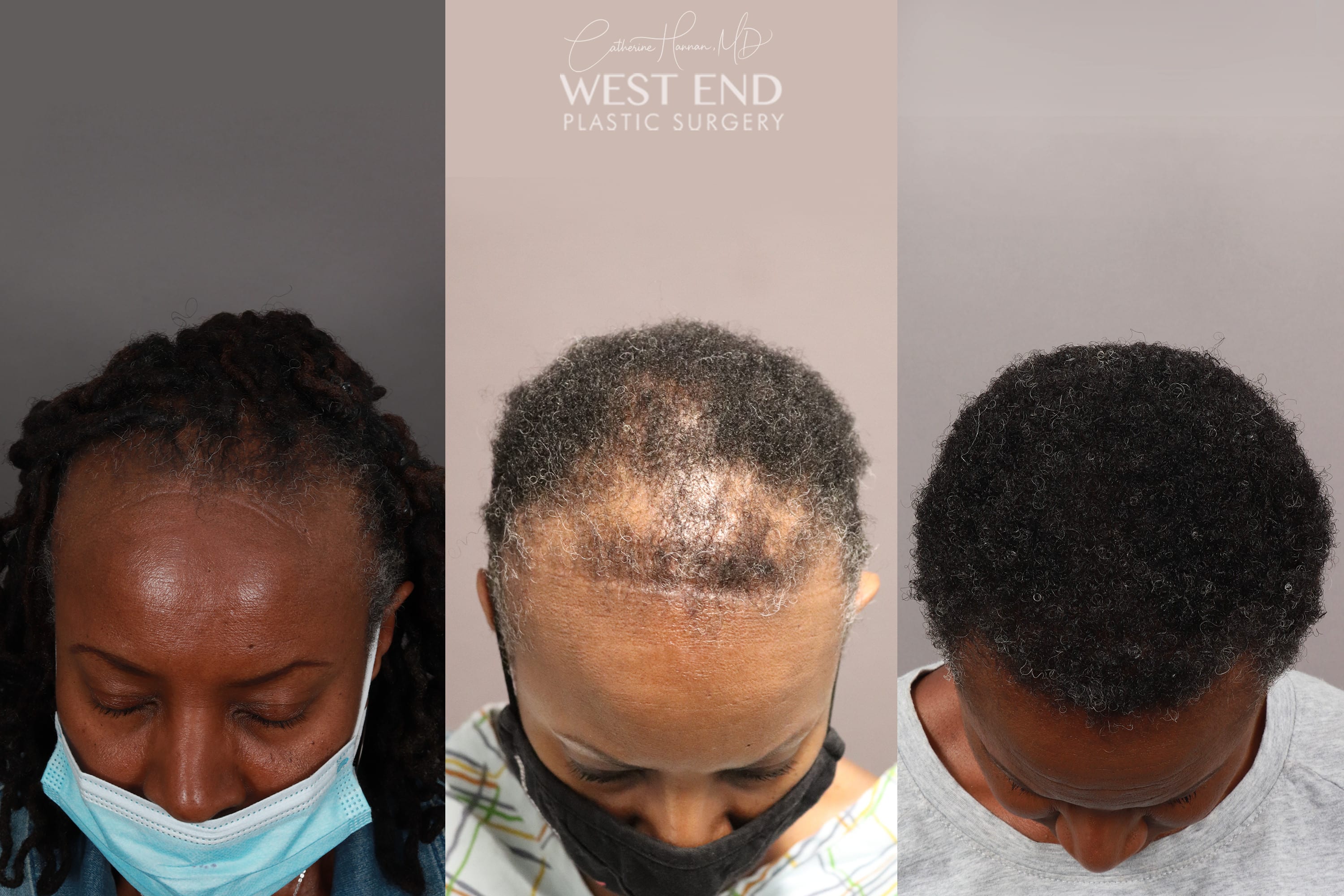 NeoGraft Hair Restoration (1 Year Post-op) before photo. Individual results may vary.