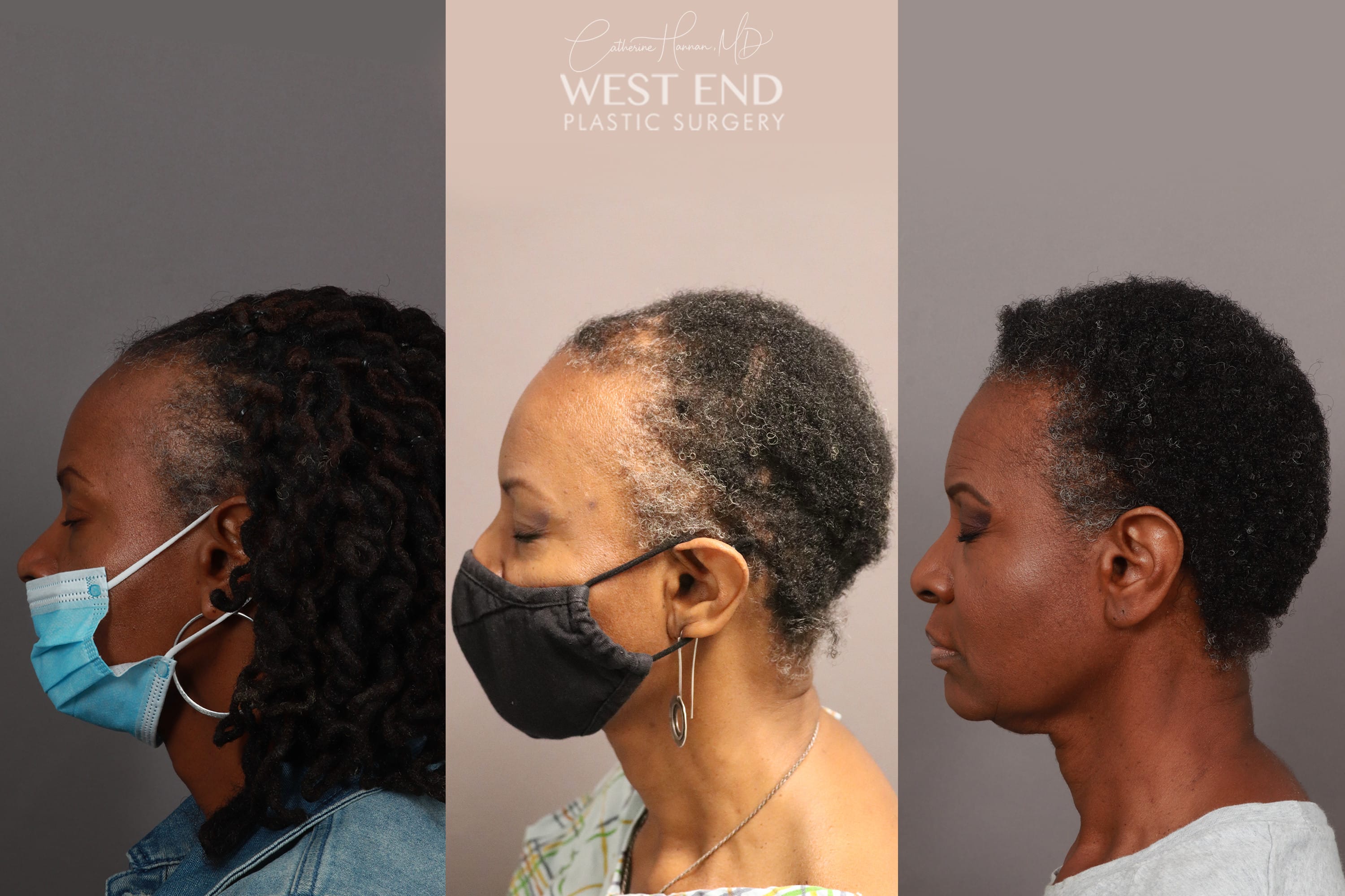 NeoGraft Hair Restoration (1 Year Post-op) before photo. Individual results may vary.