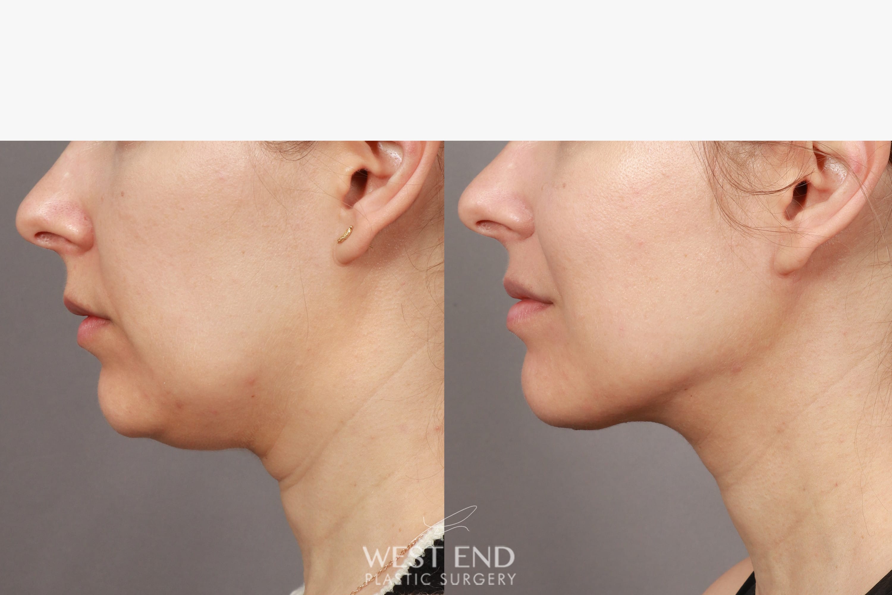 Liposuction & Renuvion Skin Tightening (1 Month Post-op) before photo. Individual results may vary.