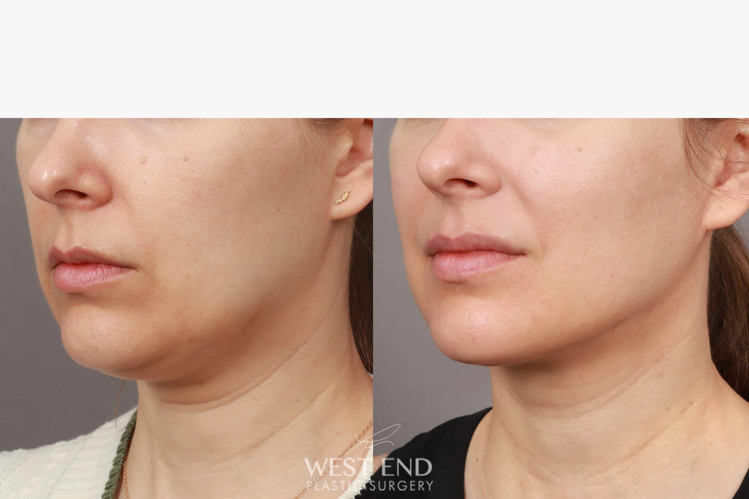 Liposuction & Renuvion Skin Tightening (1 Month Post-op) before photo. Individual results may vary.