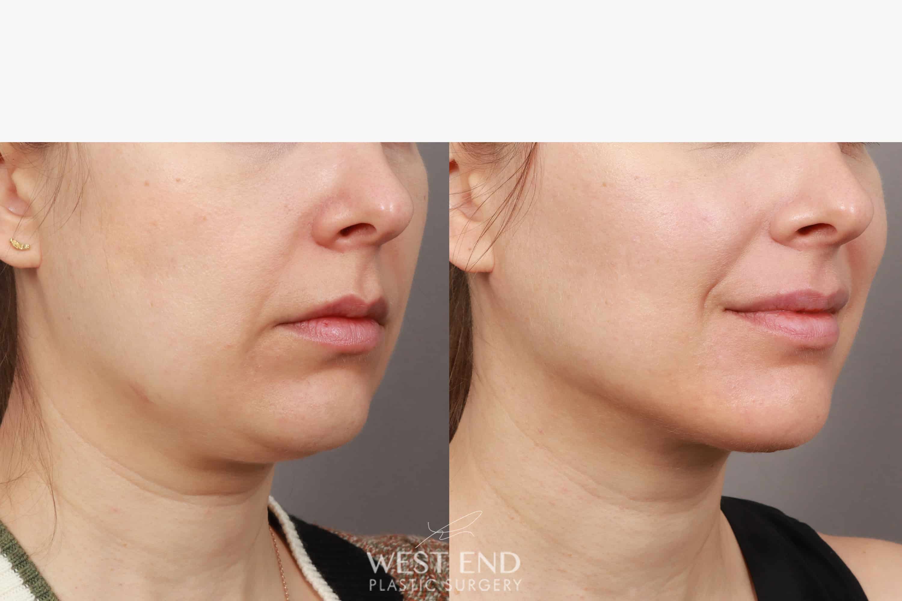 Liposuction & Renuvion Skin Tightening (1 Month Post-op) before photo. Individual results may vary.