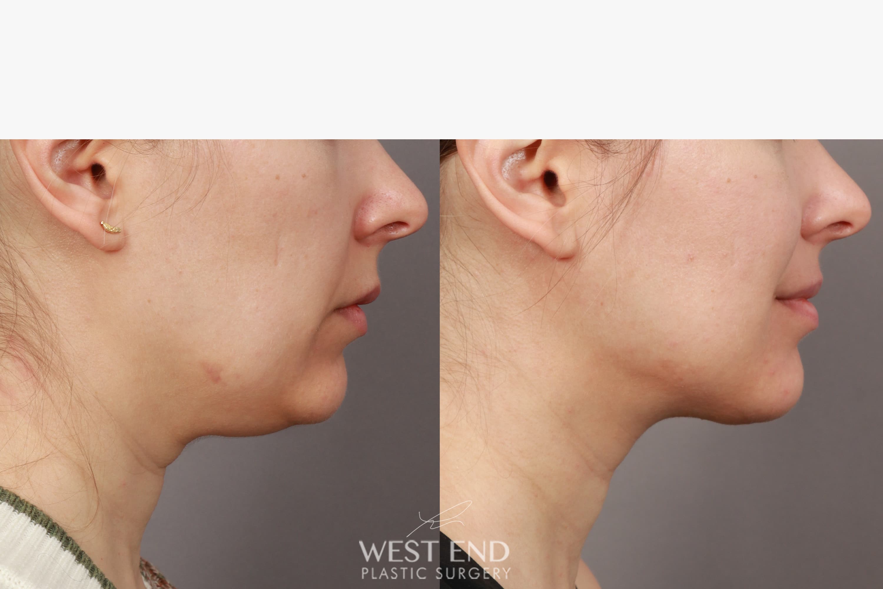 Liposuction & Renuvion Skin Tightening (1 Month Post-op) before photo. Individual results may vary.