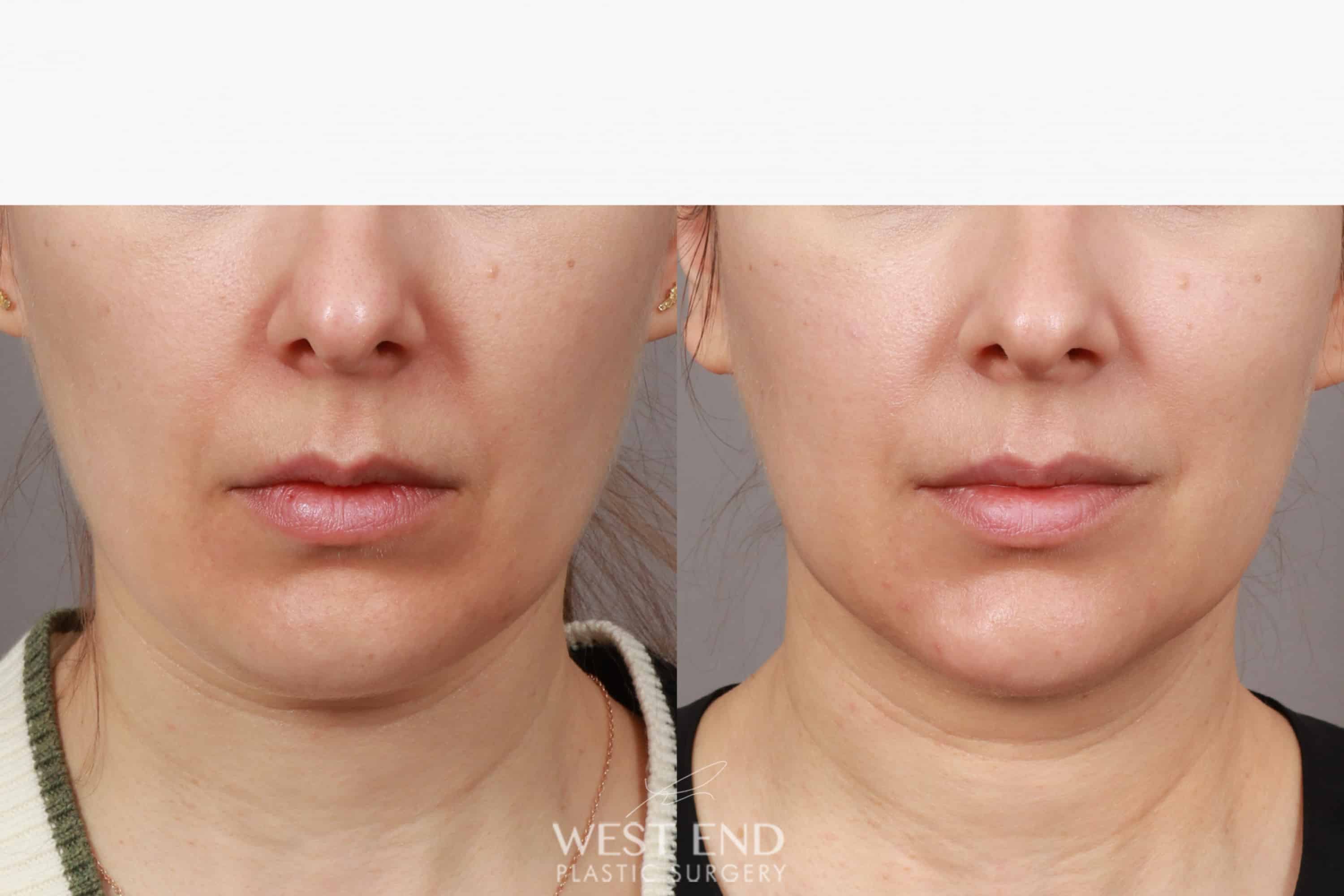 Liposuction & Renuvion Skin Tightening (1 Month Post-op) before photo. Individual results may vary.