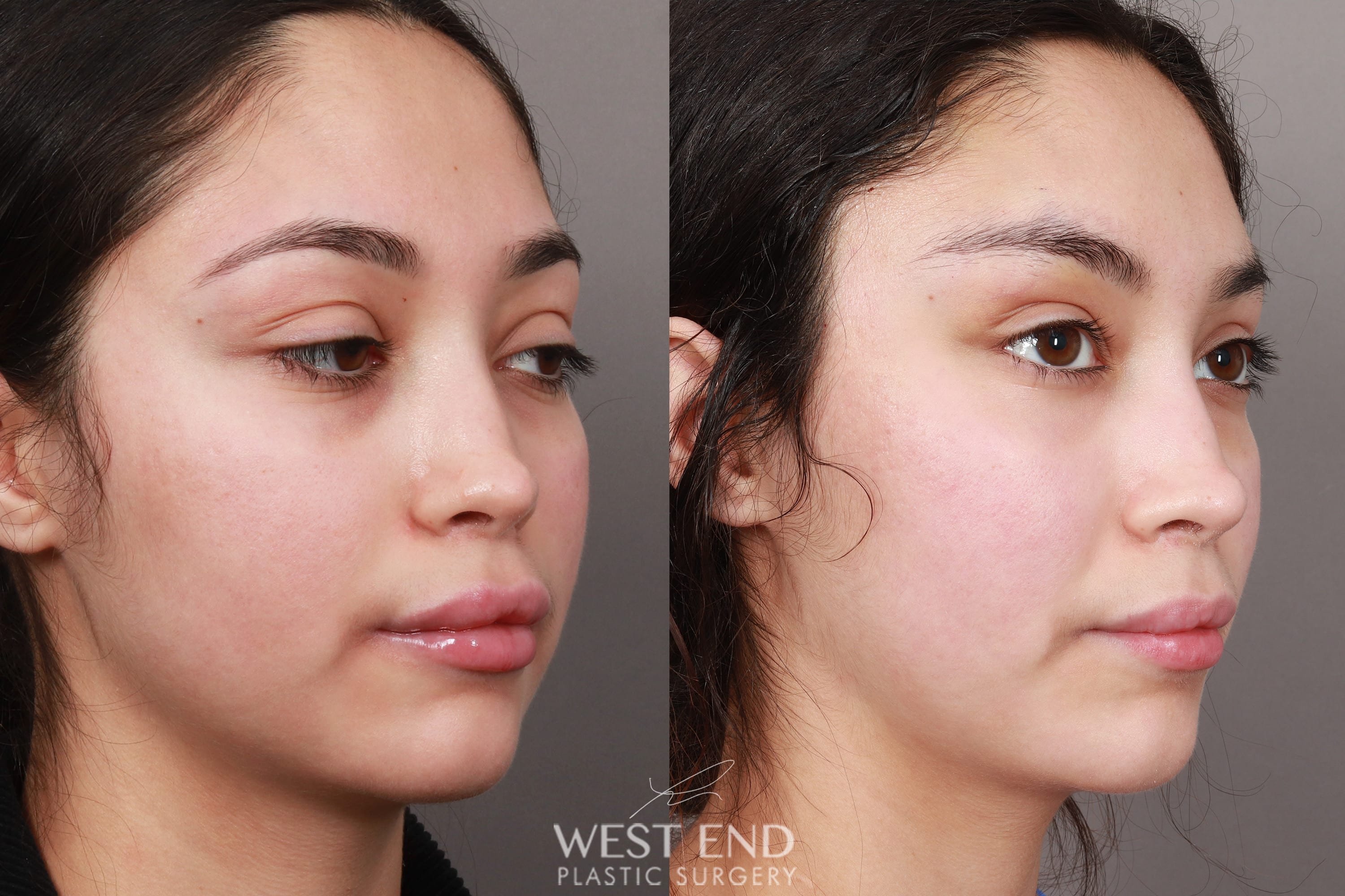 Temporal Brow Lift (1 Week Post-op) before photo. Individual results may vary.